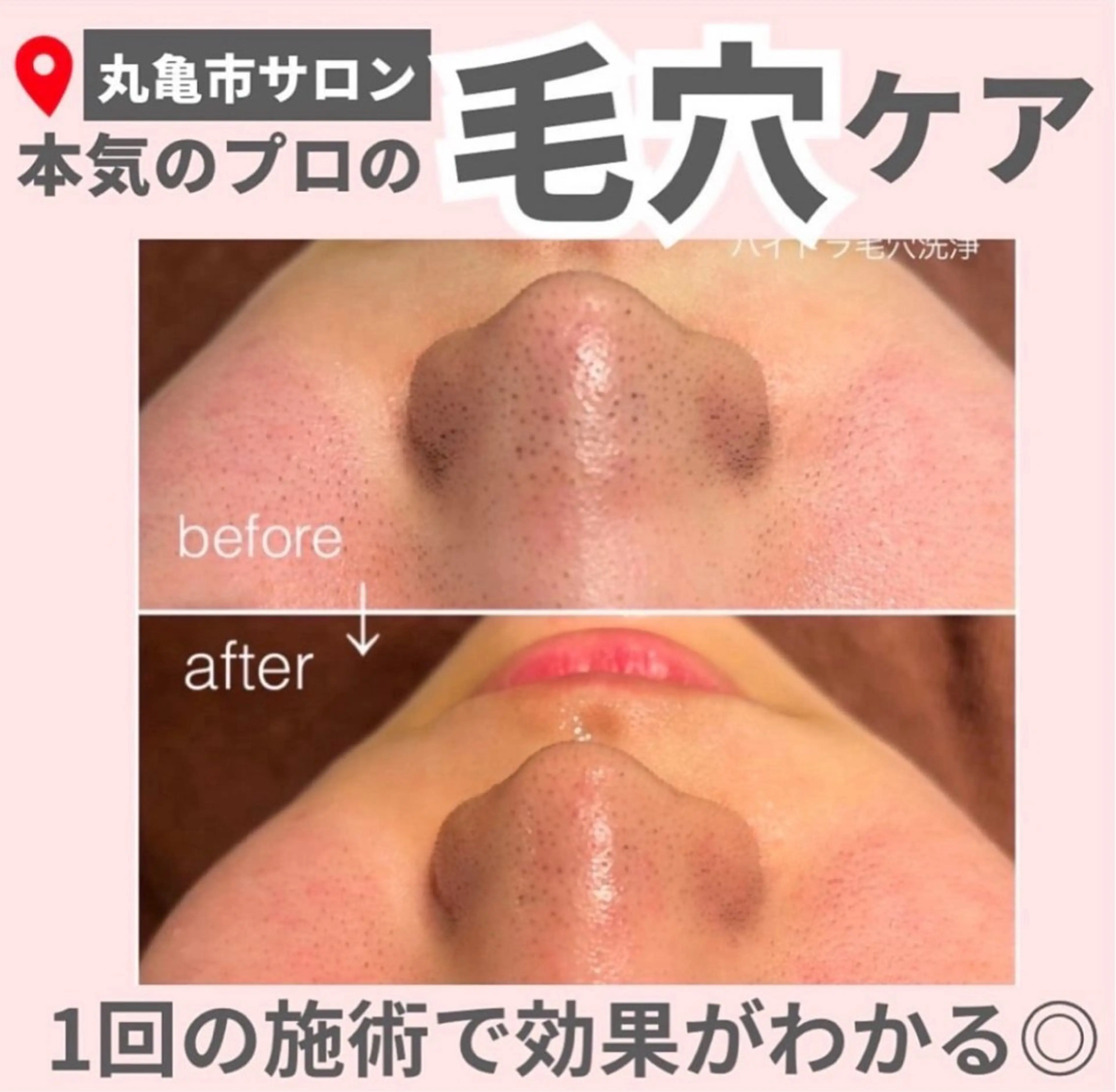 【ハイドラ美容液毛穴洗浄】毛穴の黒ずみ、汚れ、ニキビケア◎の写真