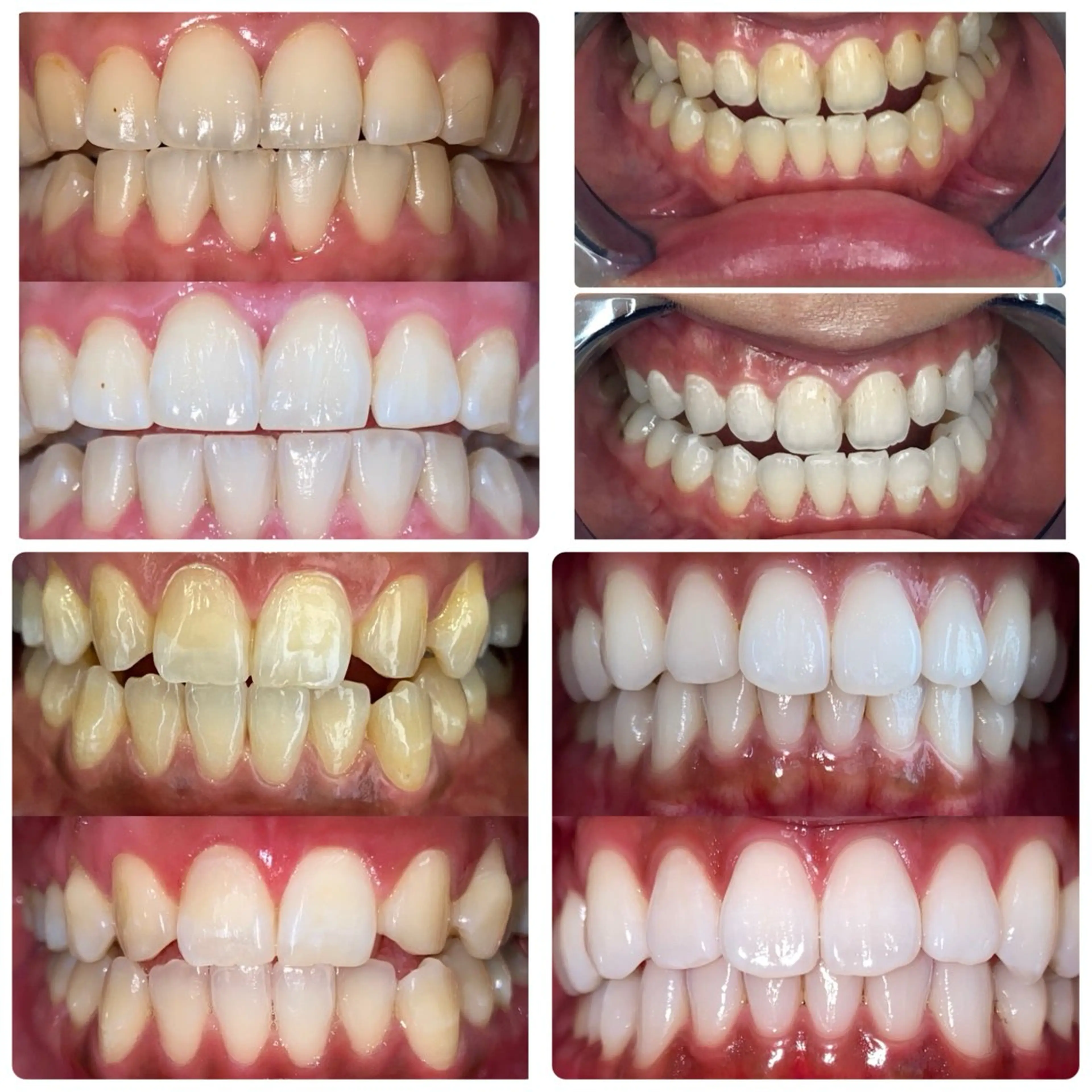 ホワイトニングサロンaile所属・セルフホワイトニング 金城しおりのその他イメージ