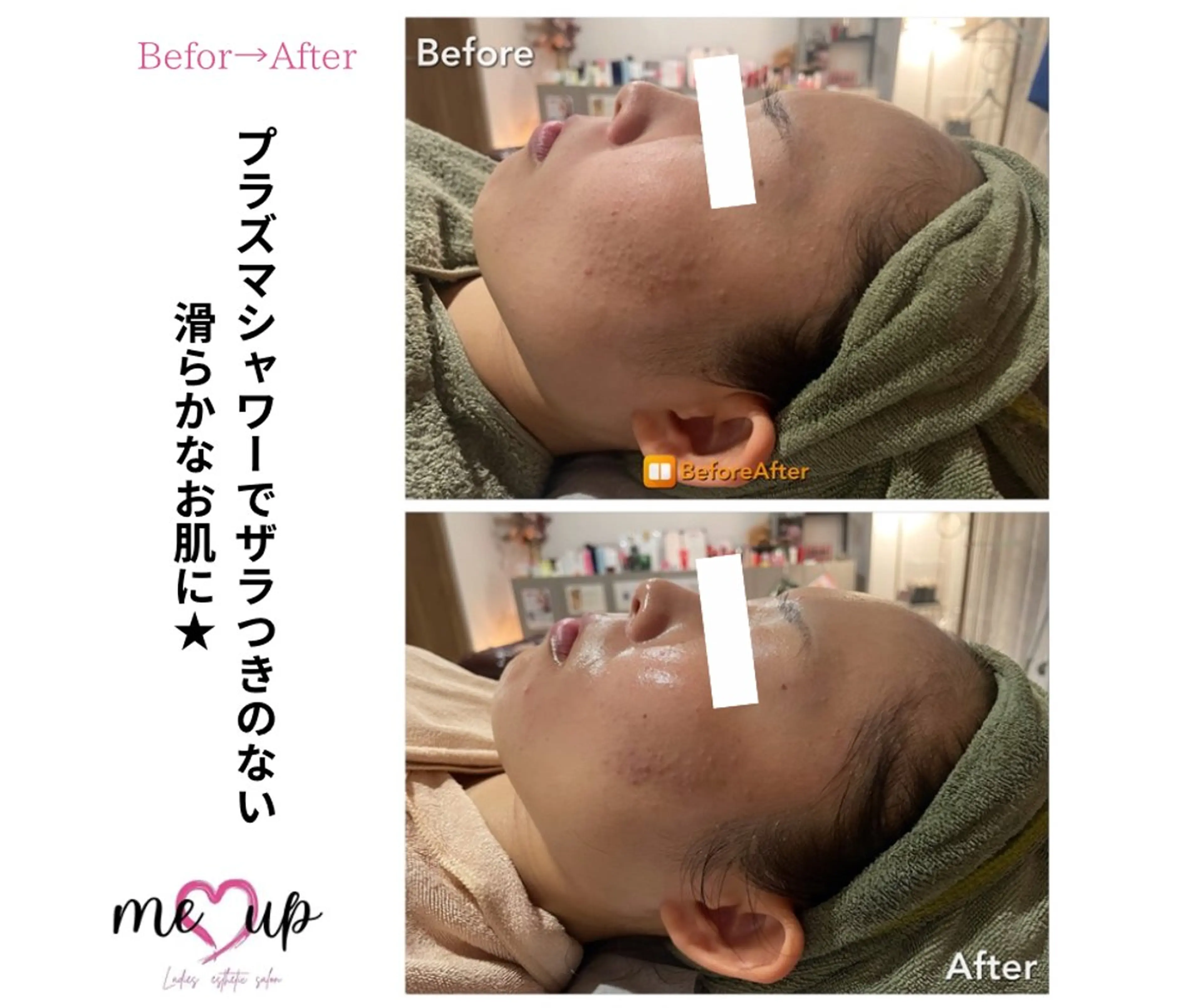 エステ Meupニキビ専門店 背中/ハーブ/ララのその他イメージ