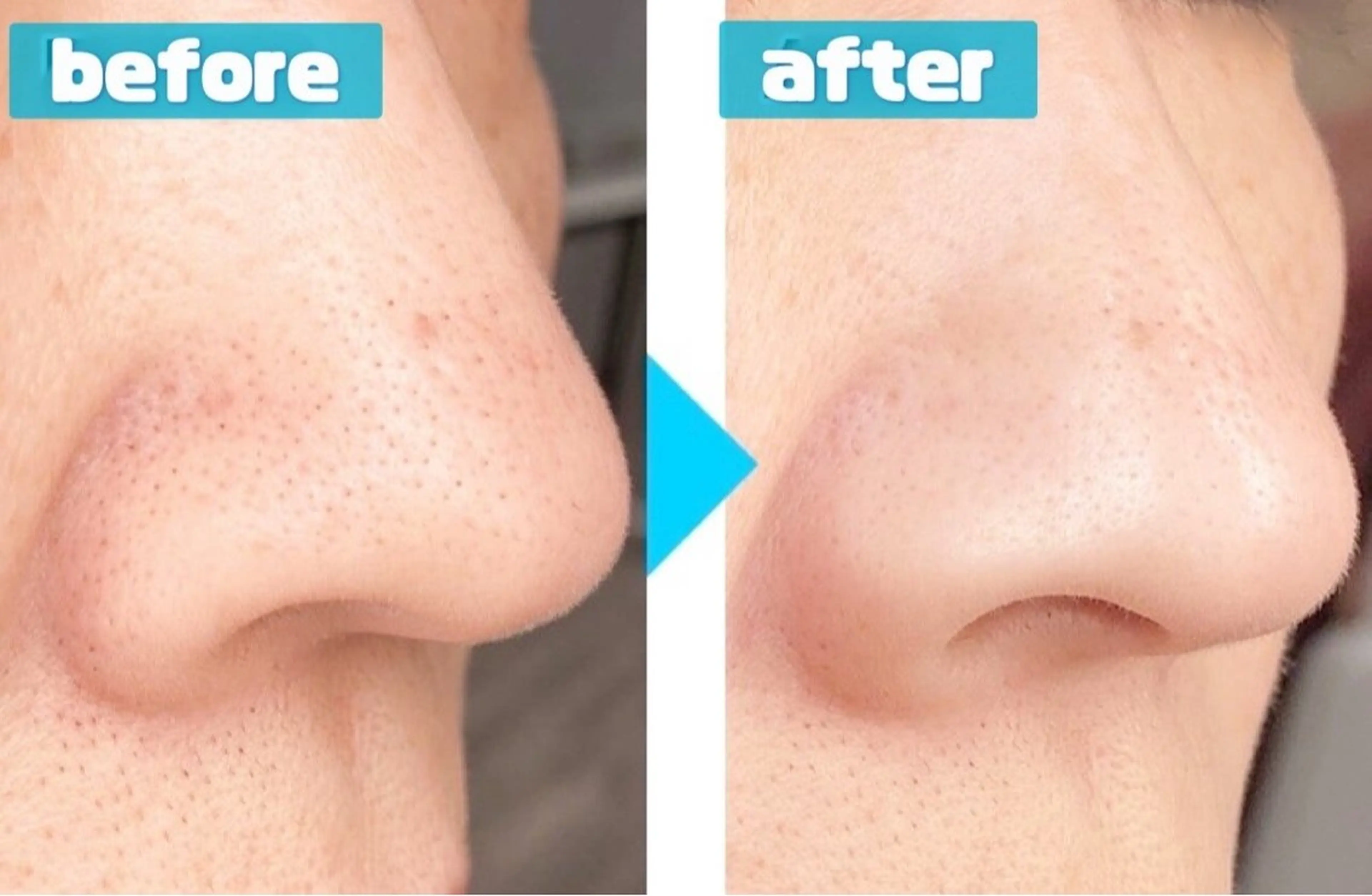 【メンズ】毛穴洗浄ハイドロフェイシャル（全顔）の写真