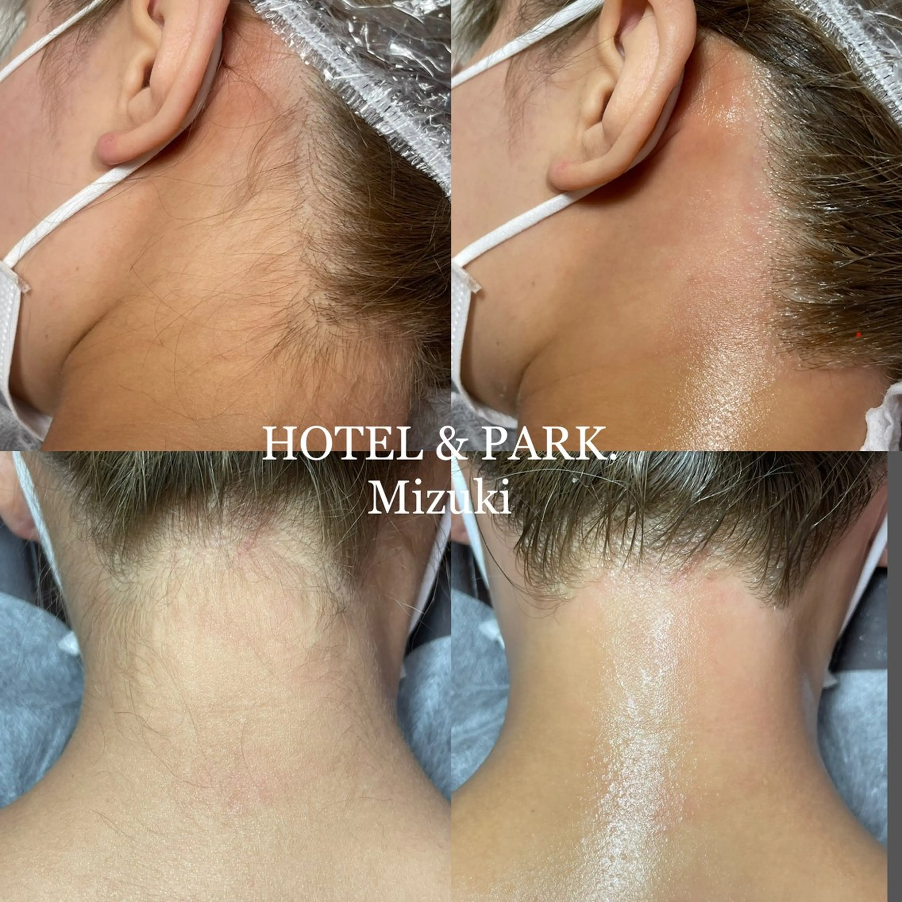 脱毛 HOTEL&PARK . ワックス脱毛のエステ・リラクイメージ