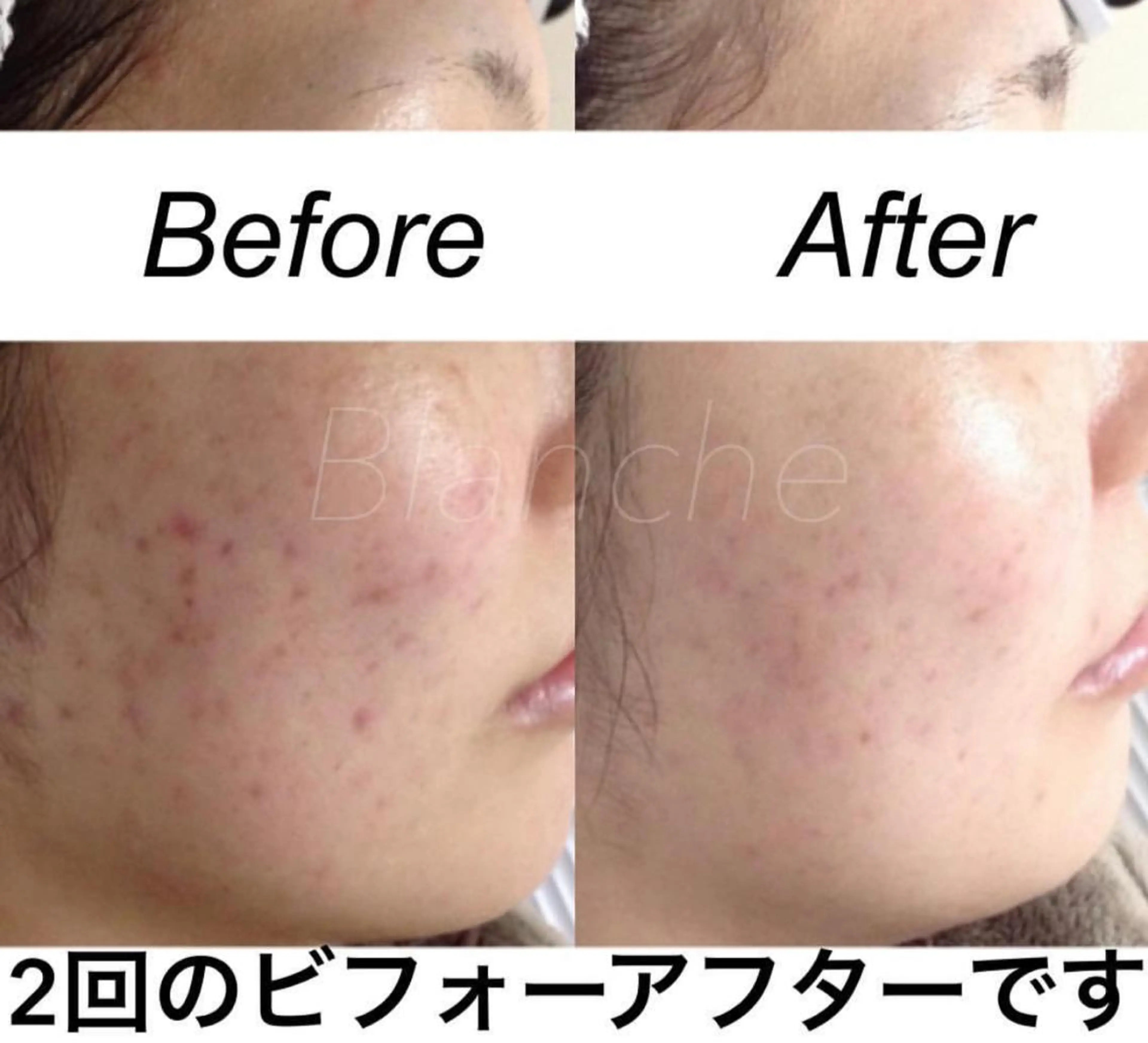 ミディアム カラー パーマ ヘアアレンジ キッズ ネイル マツエク・マツパ エステ リラク 都度払い肌質改善 &脱毛Blancheのエステ・リラクイメージ