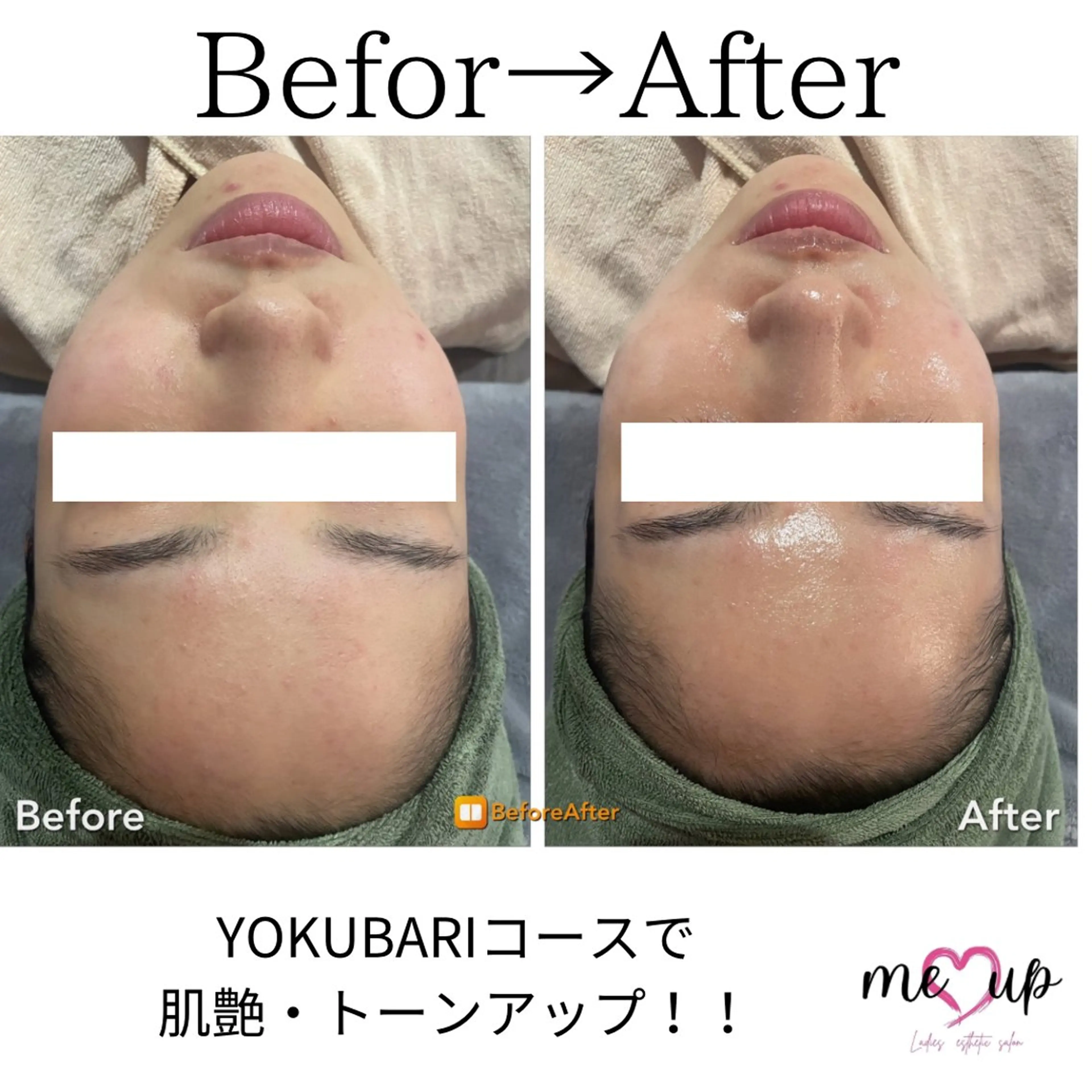 Meupニキビ専門店 背中/ハーブ/ララのその他イメージ