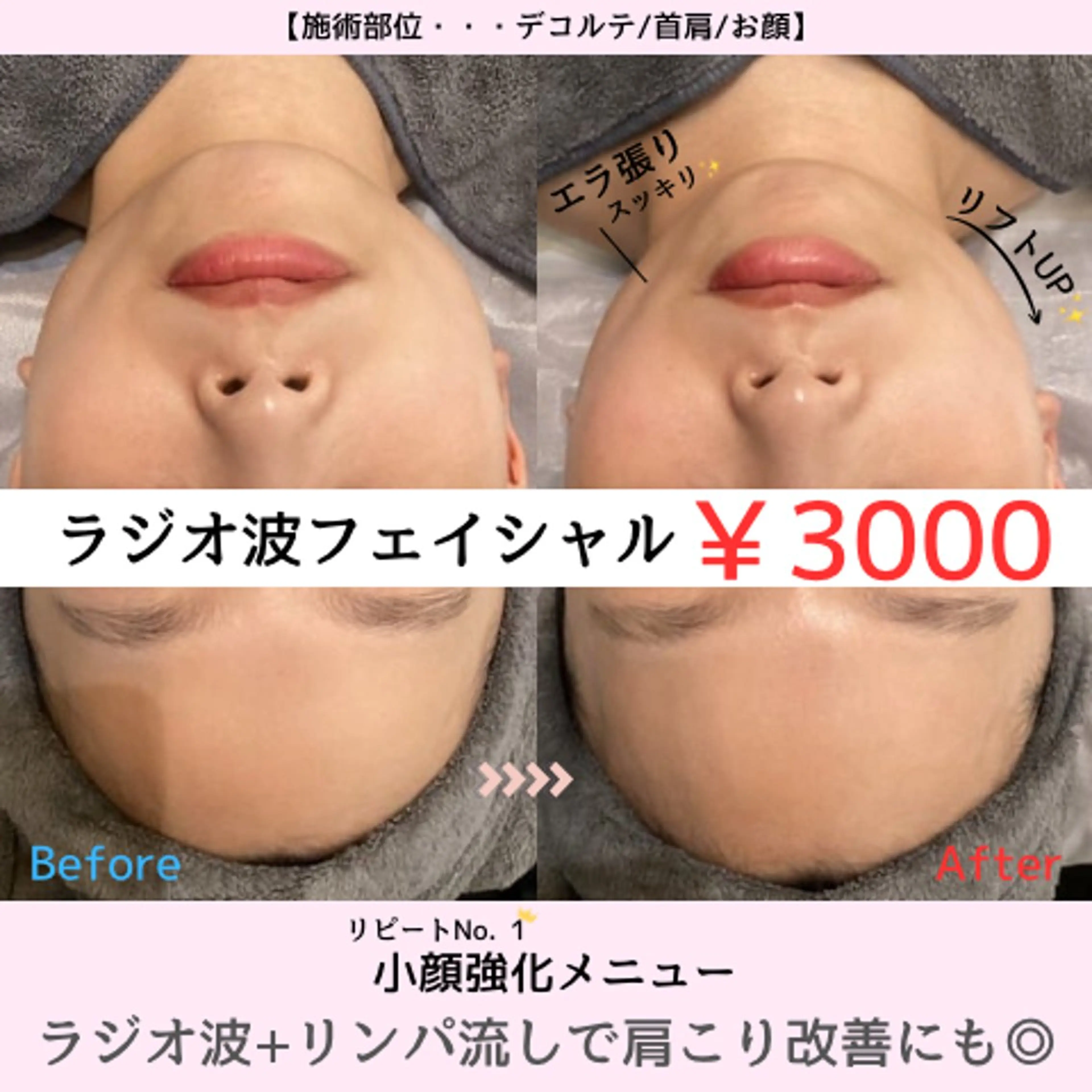 立体小顔♪ラジオ波フェイシャル💆‍♀️リフトUP・二重アゴ他、脇肉ケアやブライダルに人気✨¥11000→¥3000の写真