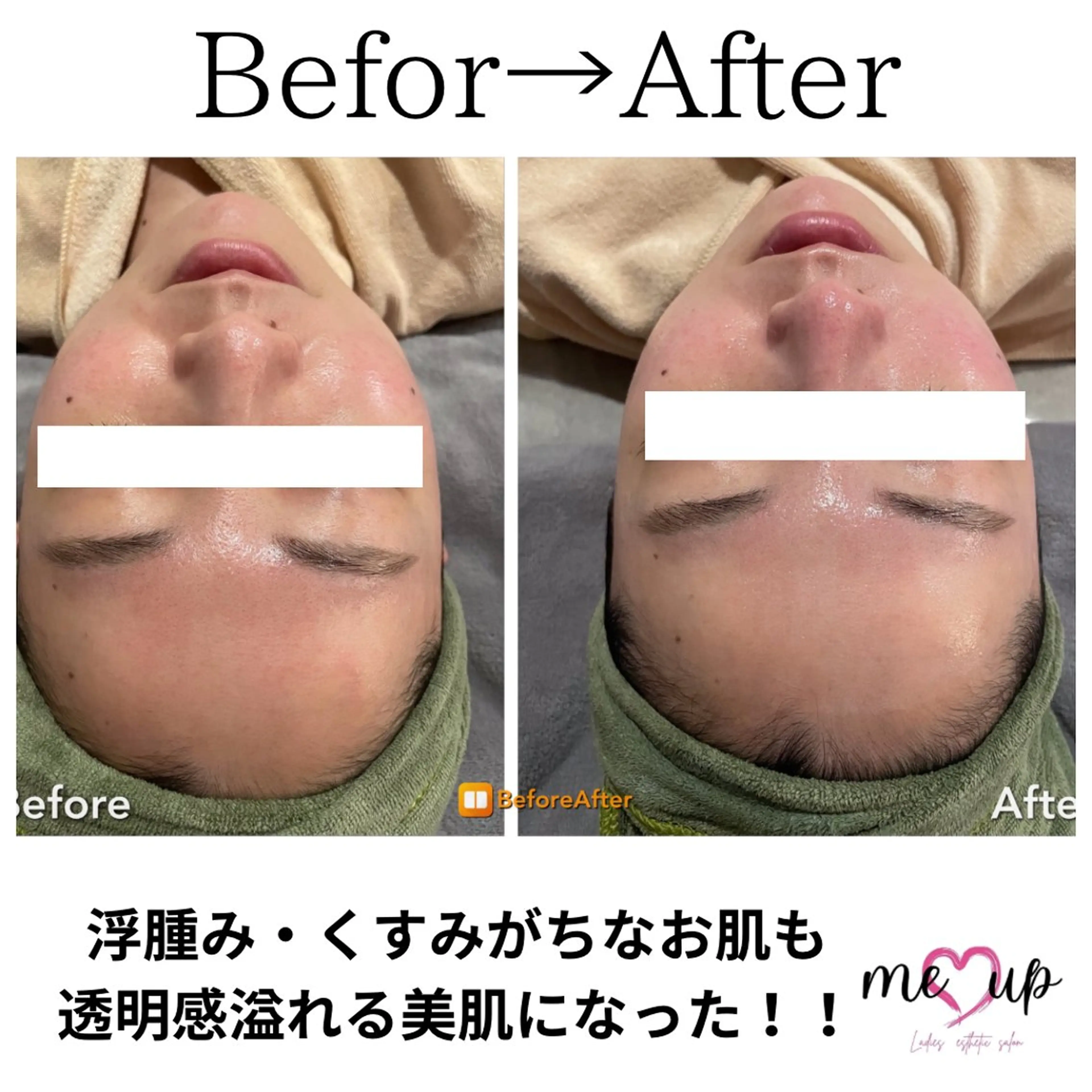 Meupニキビ専門店 背中/ハーブ/ララのその他イメージ