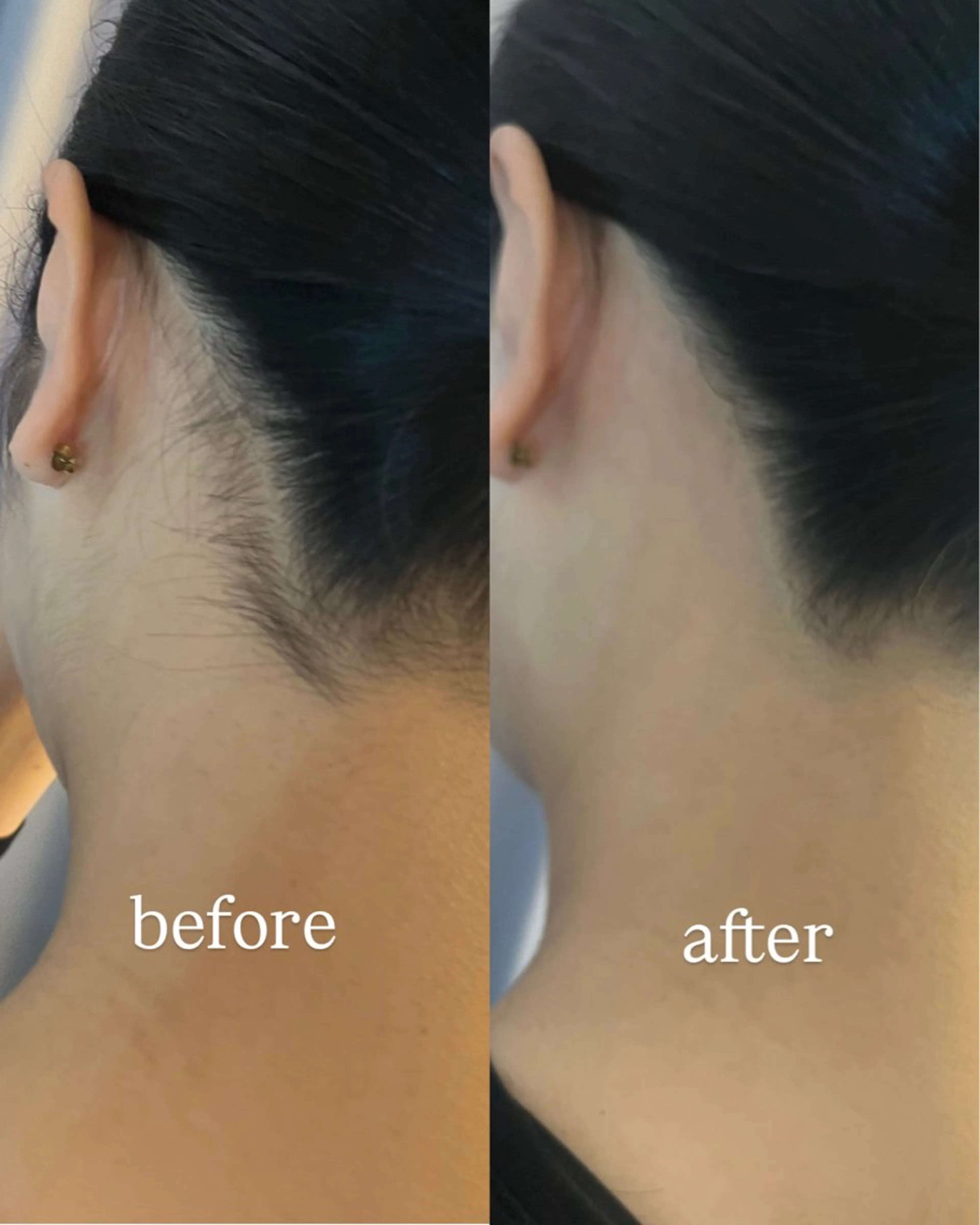 うなじ脱毛/美肌脱毛 LABELのエステ・リラクイメージ