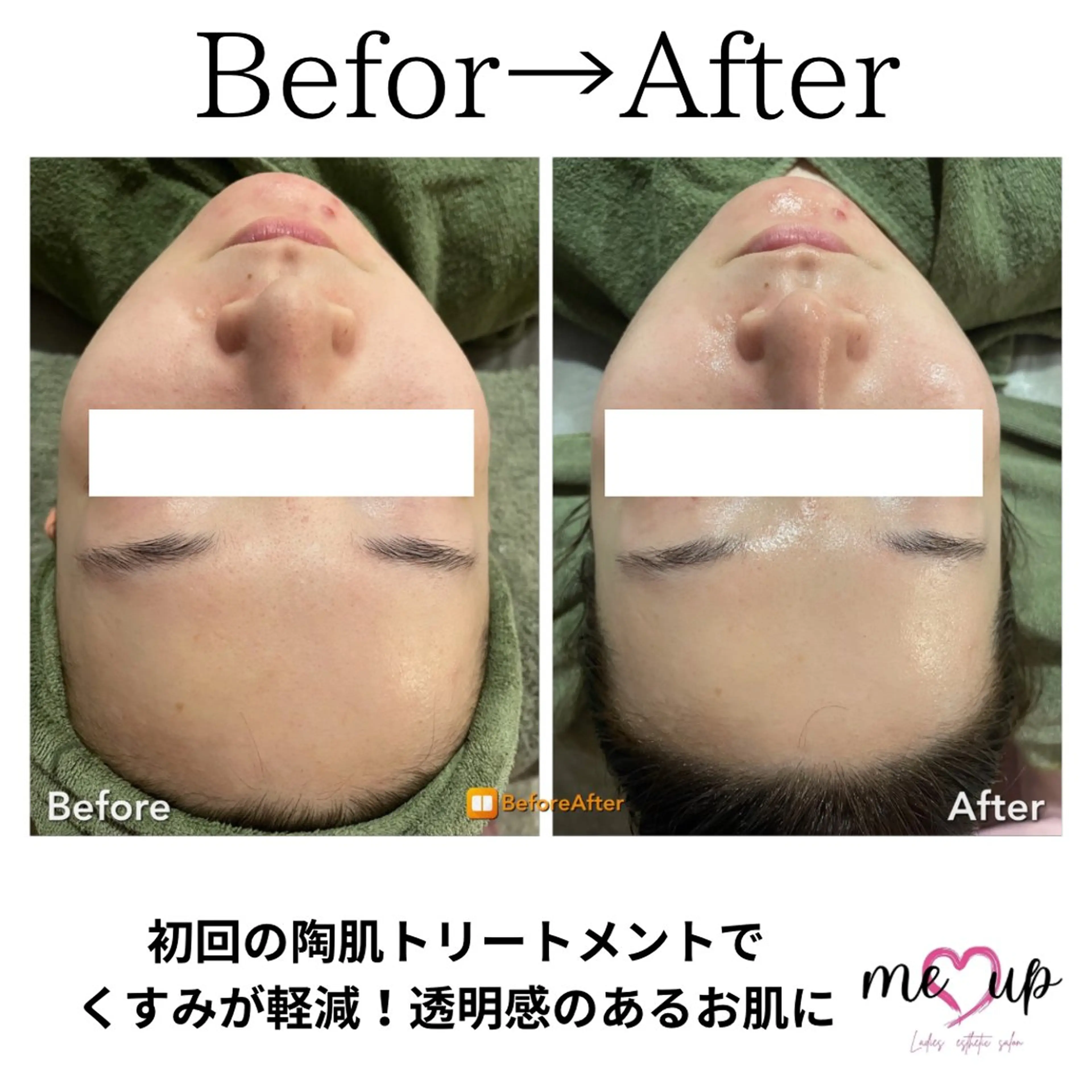 エステ Meupニキビ専門店 背中/ハーブ/ララのその他イメージ