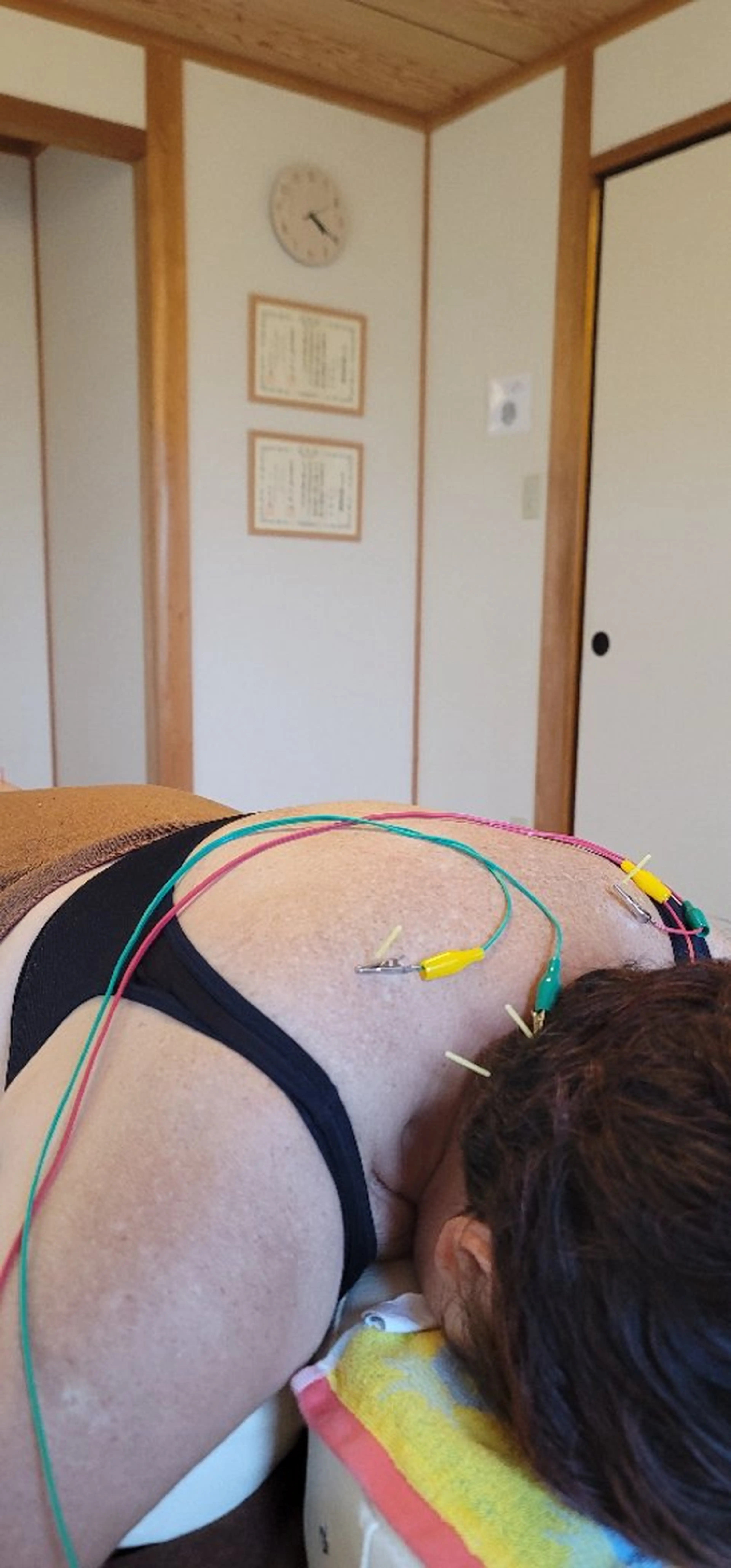 [肩こり・腰痛特化]初回鍼灸の写真