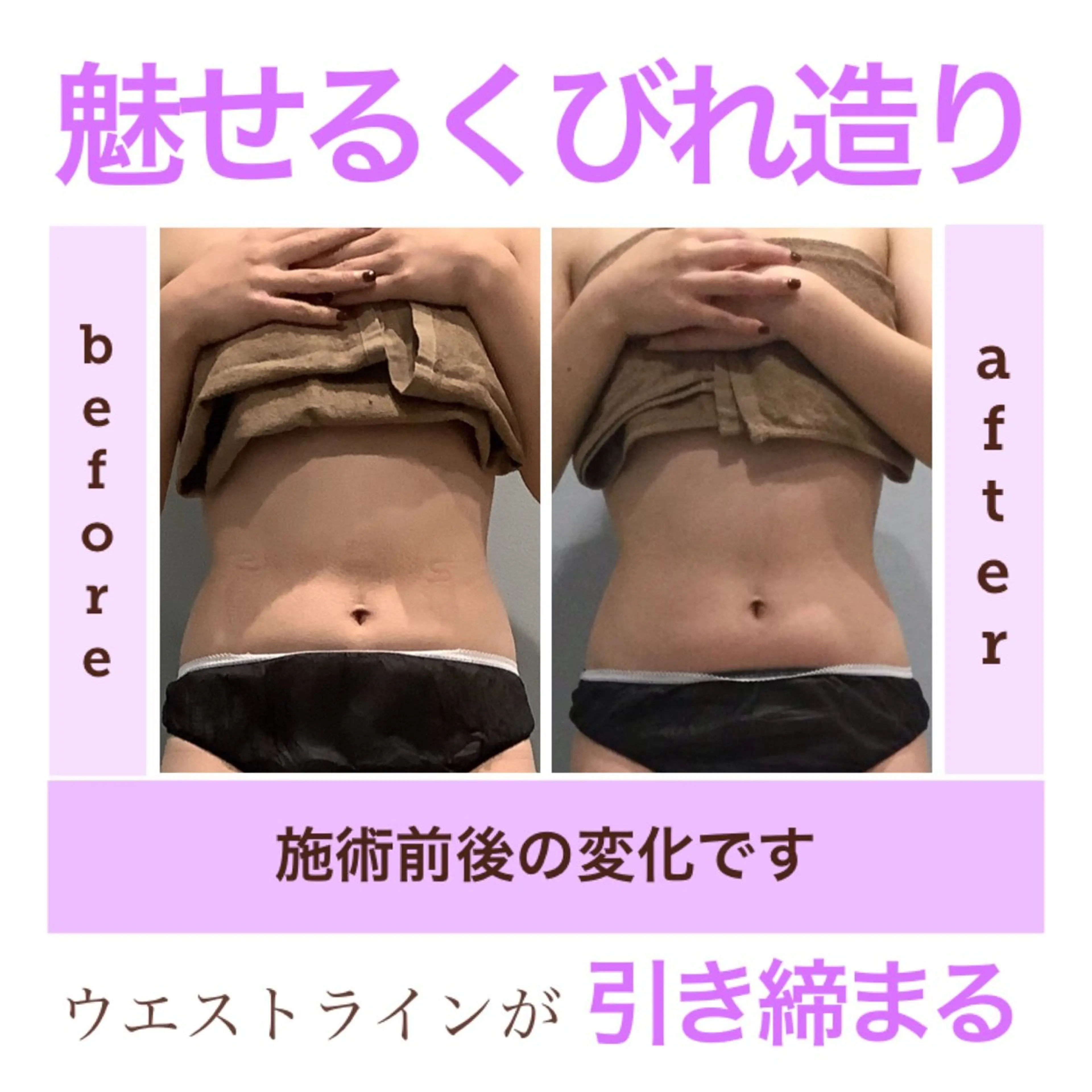 痩身 #キャビテーション #ラジオ波 #吸引 #EMS #お腹痩せ