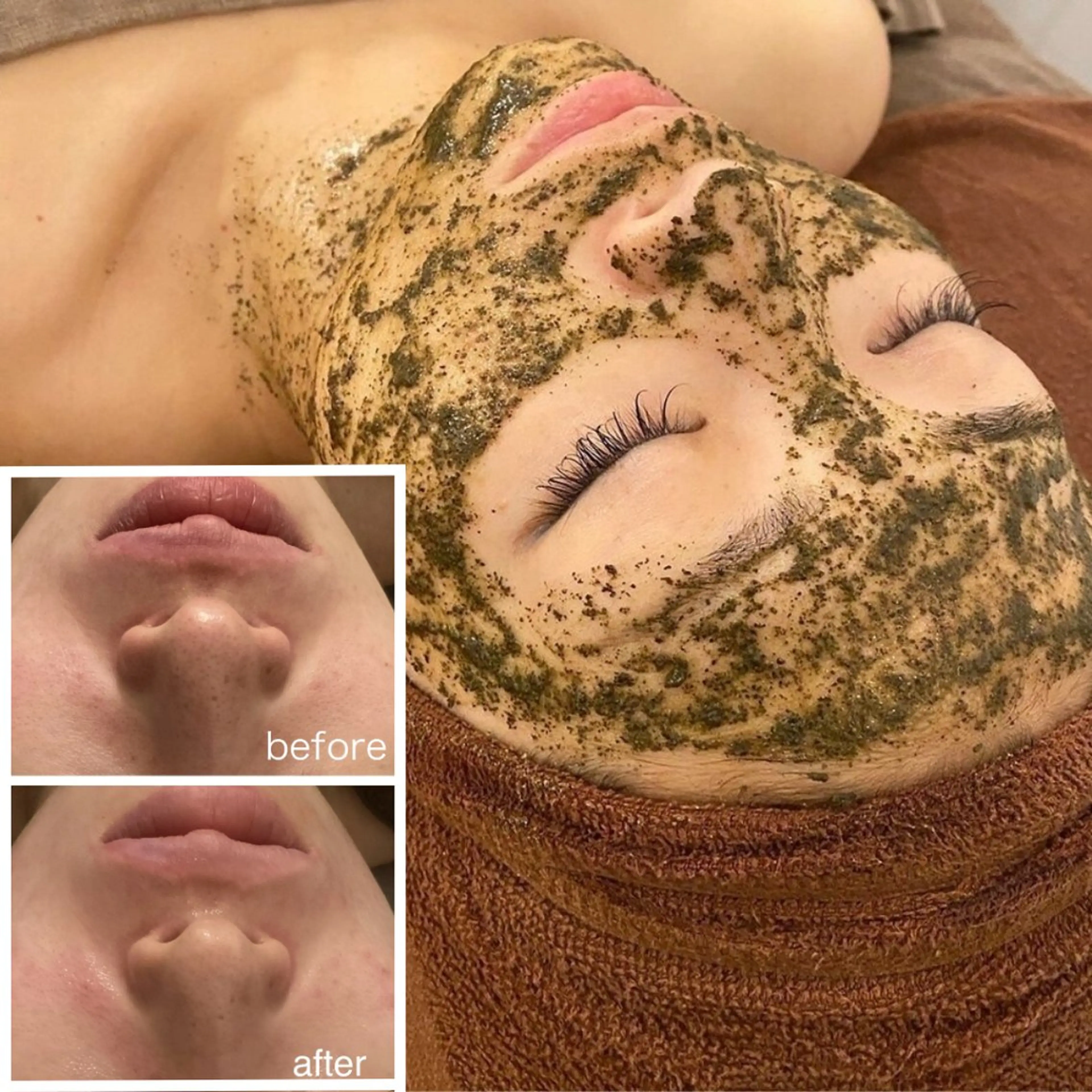 【超お得🉐毛穴ケア】ハーブピーリング🌿×毛穴洗浄の最強コンビ¥24000→¥16800の写真
