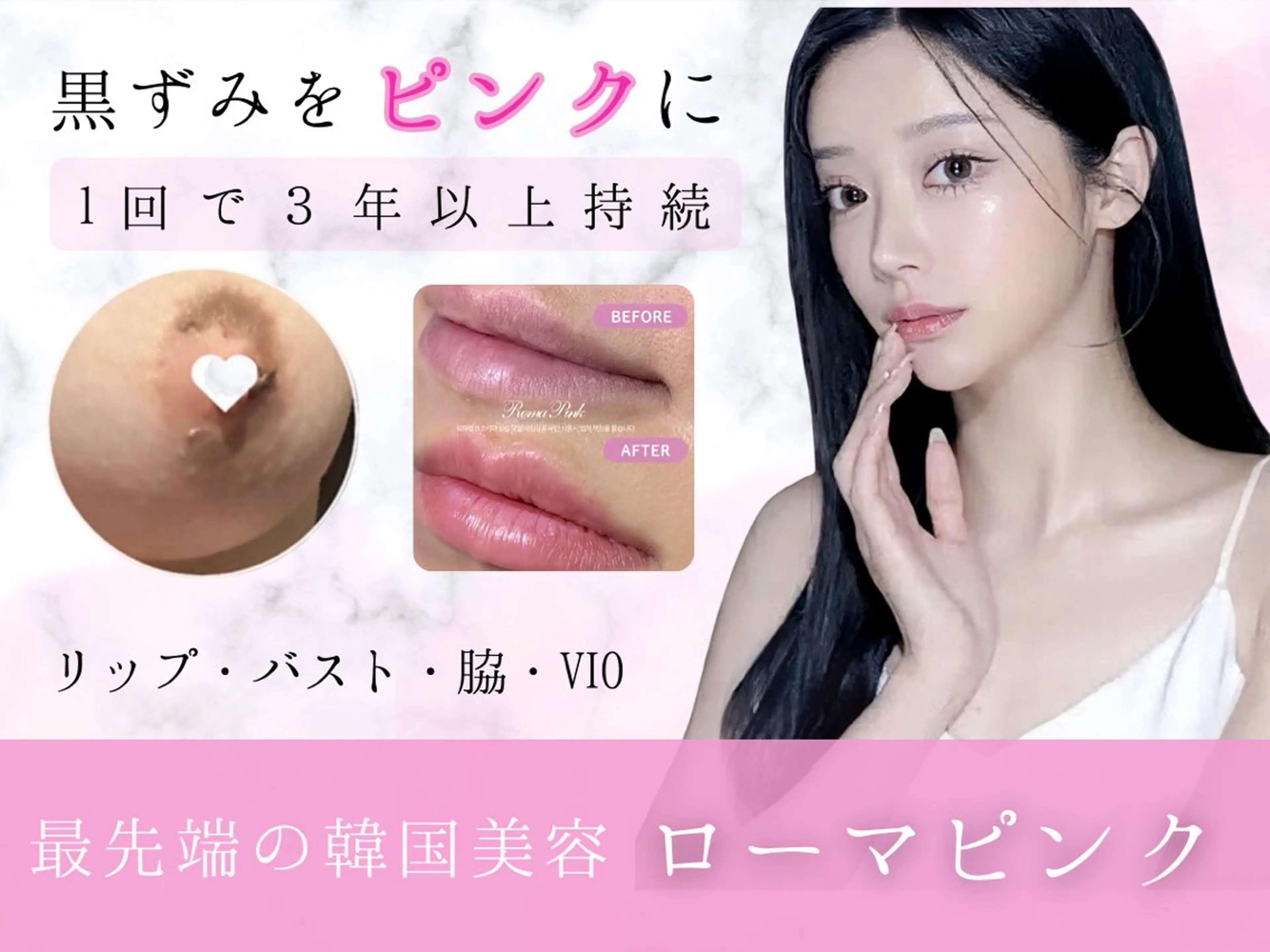 【黒ずみケア】話題のローマピンクで黒ずみケア！赤ちゃんピンクを取り戻して自信溢れる未来へ◎カウンセリング→当日施術可能◎の写真