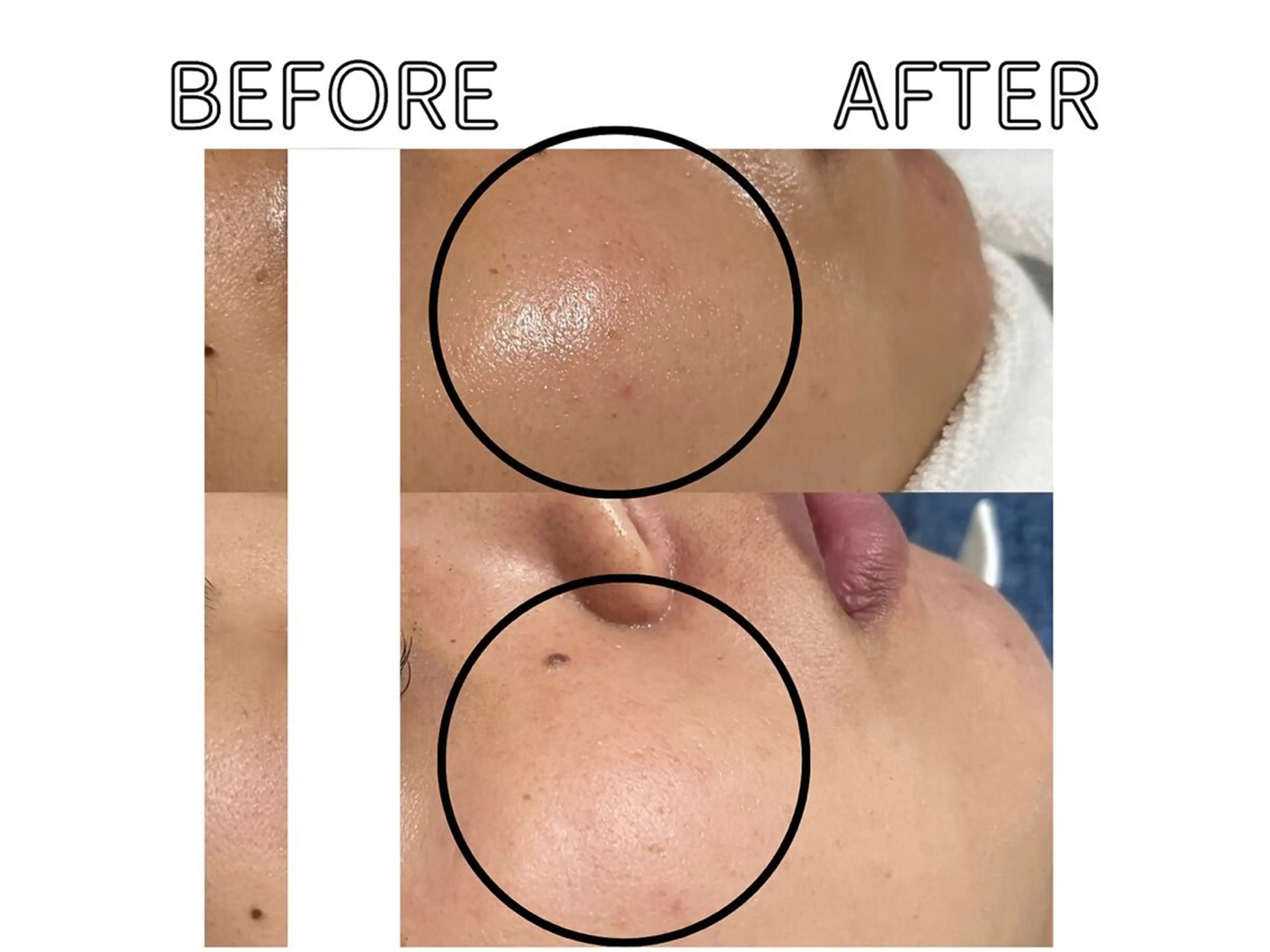 ハーブピーリング LIME池袋東口のエステ・リラクイメージ