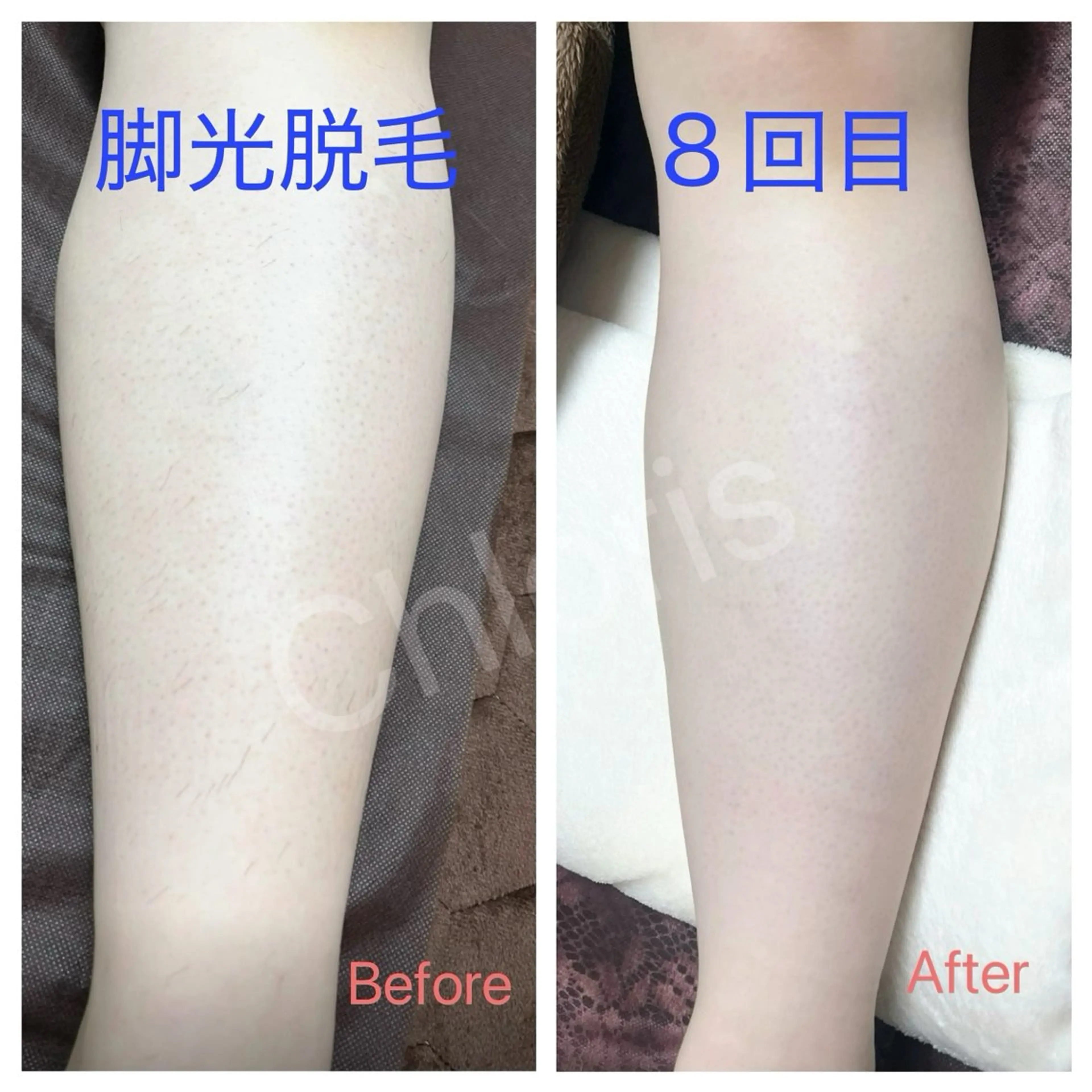 【初回限定】脚まるごと脱毛の写真