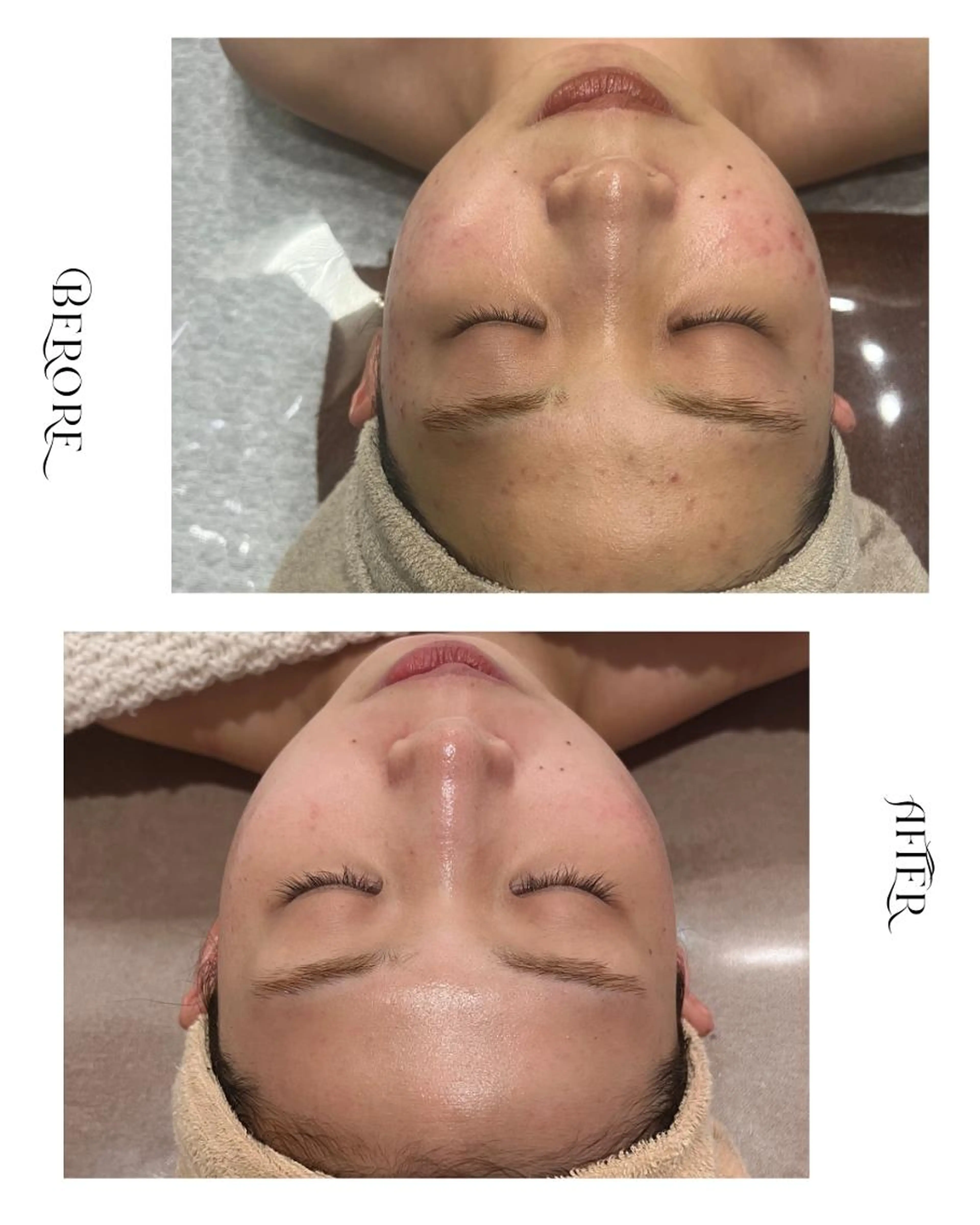 《ツヤ｜肌質改善》艶肌ワックス＋美顔機器フェイシャルの写真