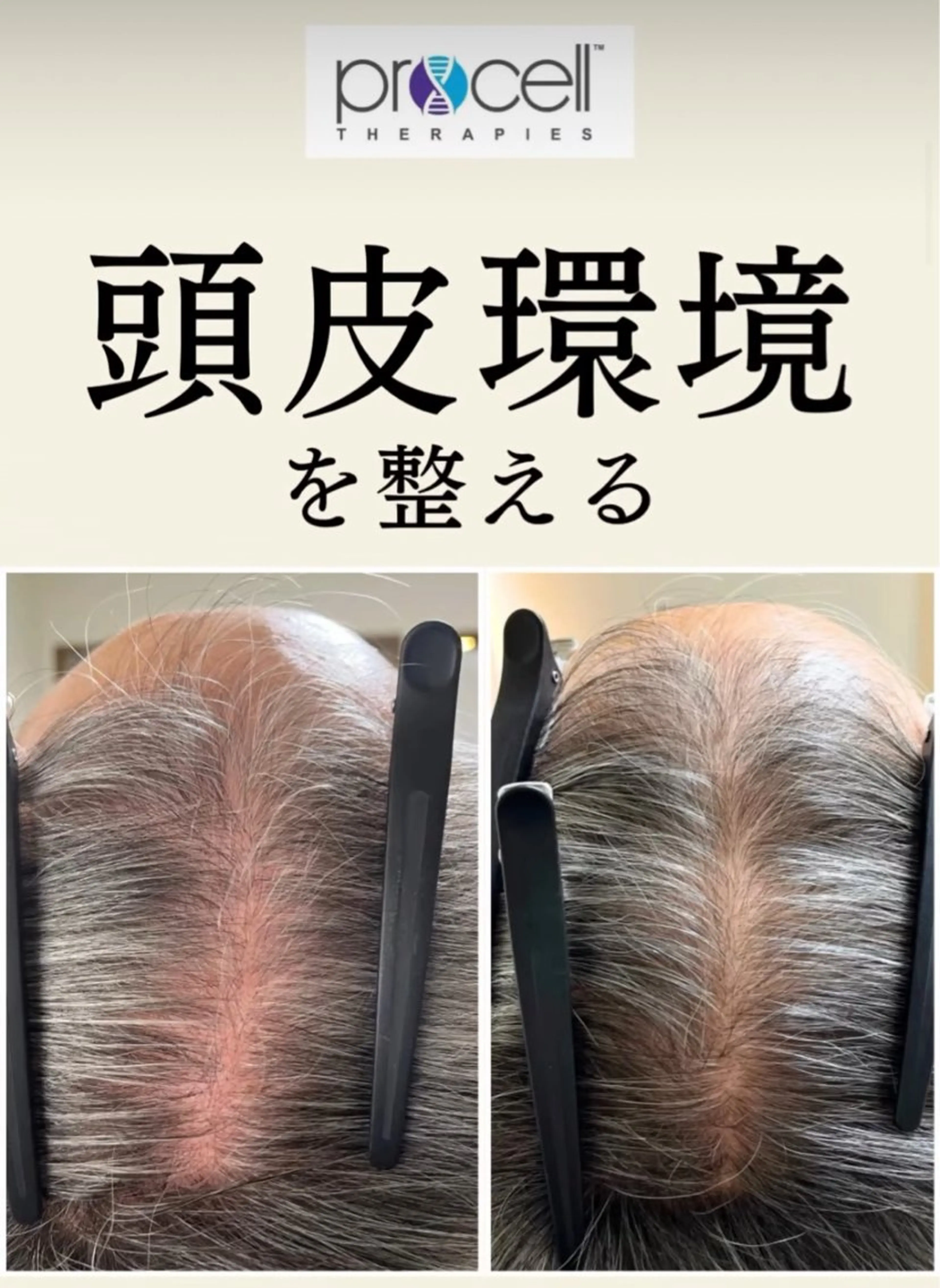 プロセルセラピー　モデル（8月17日限定）の写真