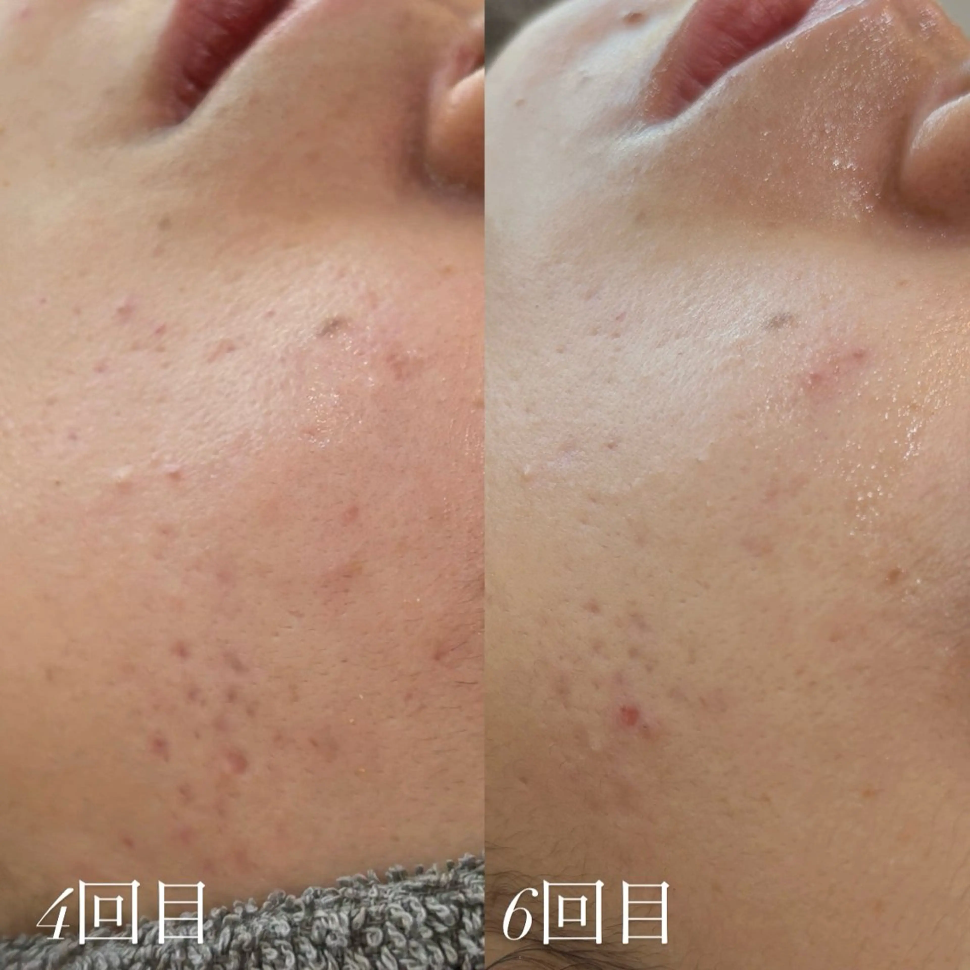 よもぎ蒸し×ハーブピーリング【foi】所属・foi🌿 MIHOのエステ・リラクイメージ