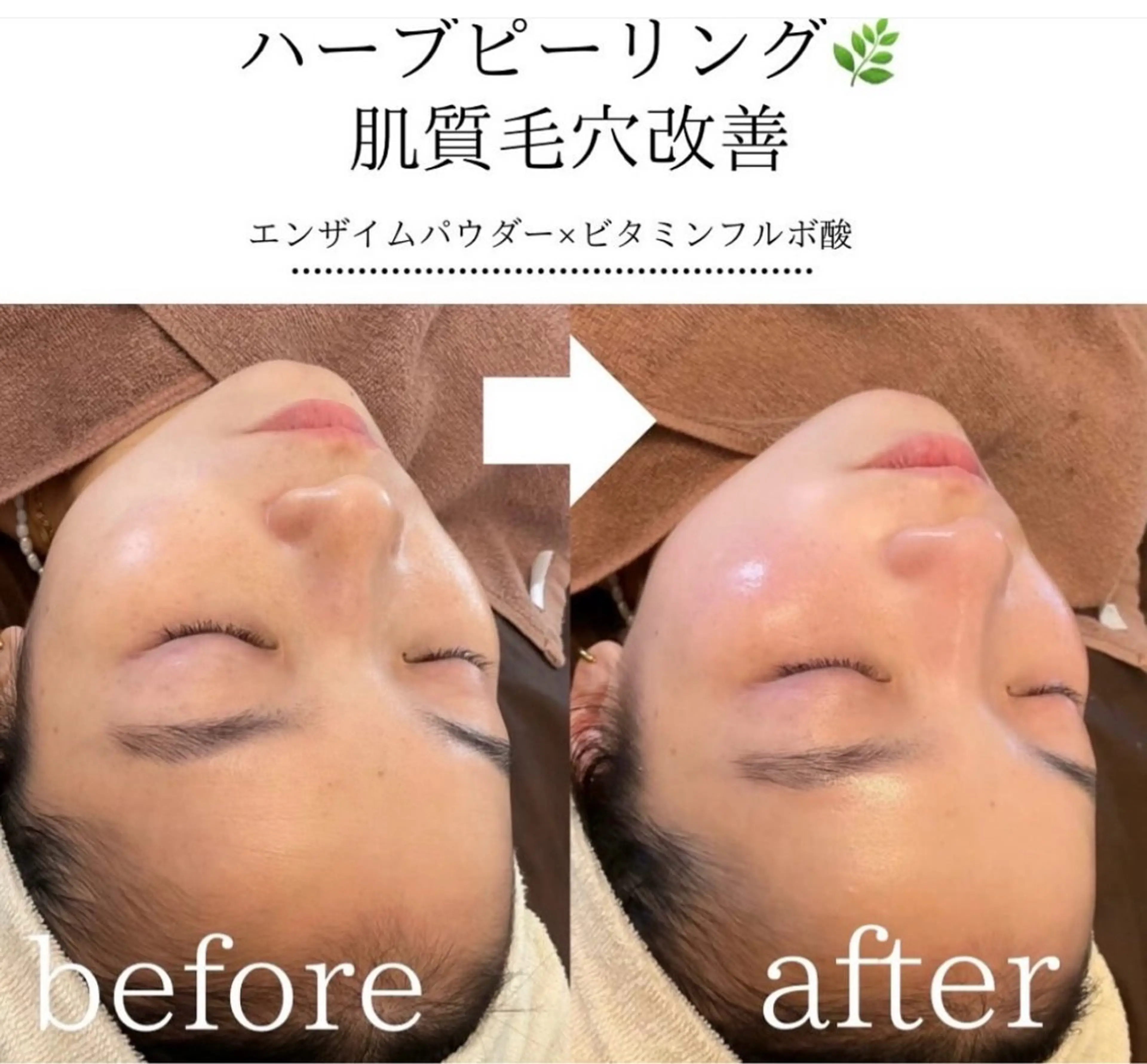 【圧倒的人気No1★】REVI剥離無しハーブピーリング+オプション2つ◎20900→¥8800の写真