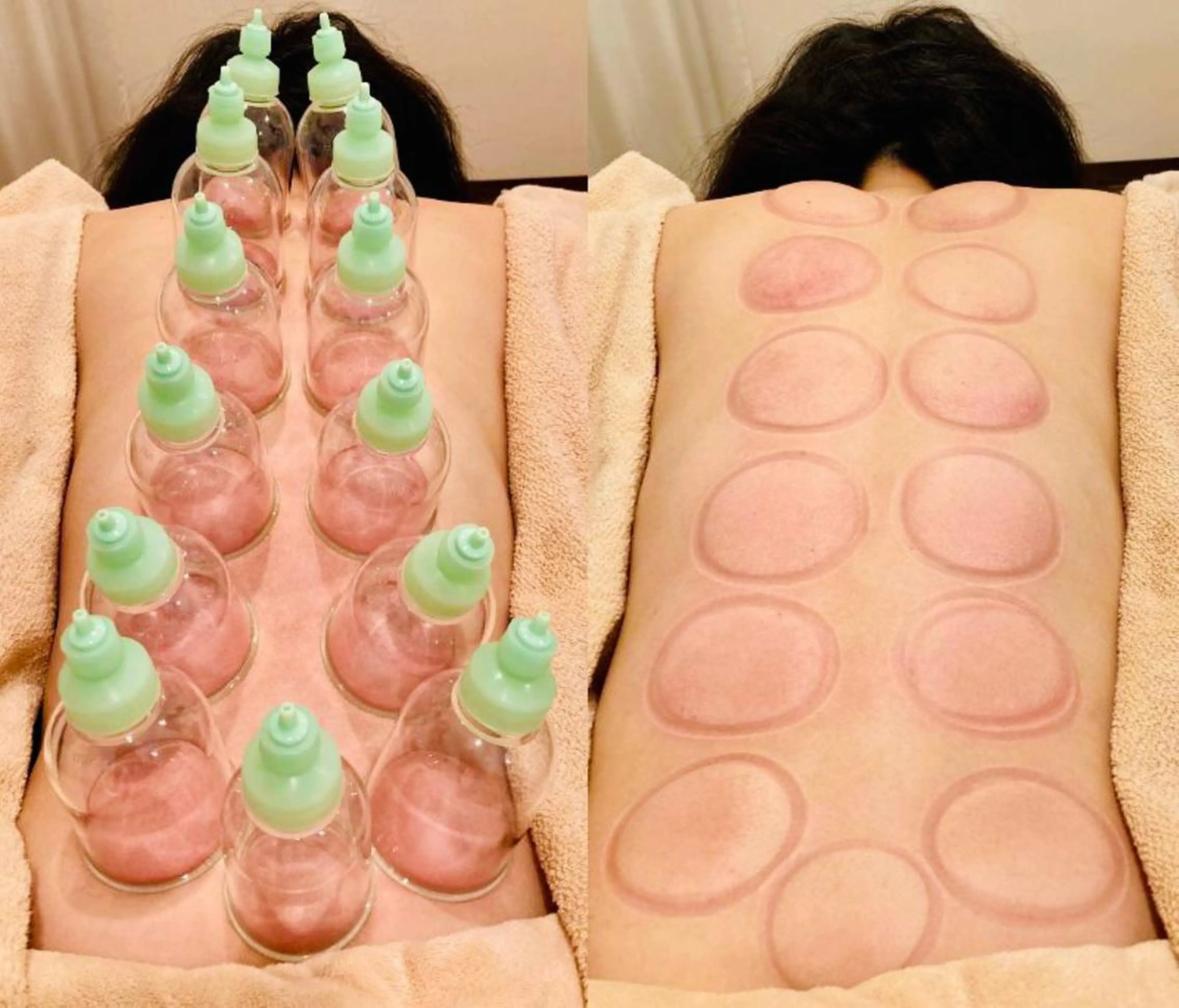背中トリートメント×カッピング療法✨💆‍♀️お身体の毒素をとことん取り除きます。の写真