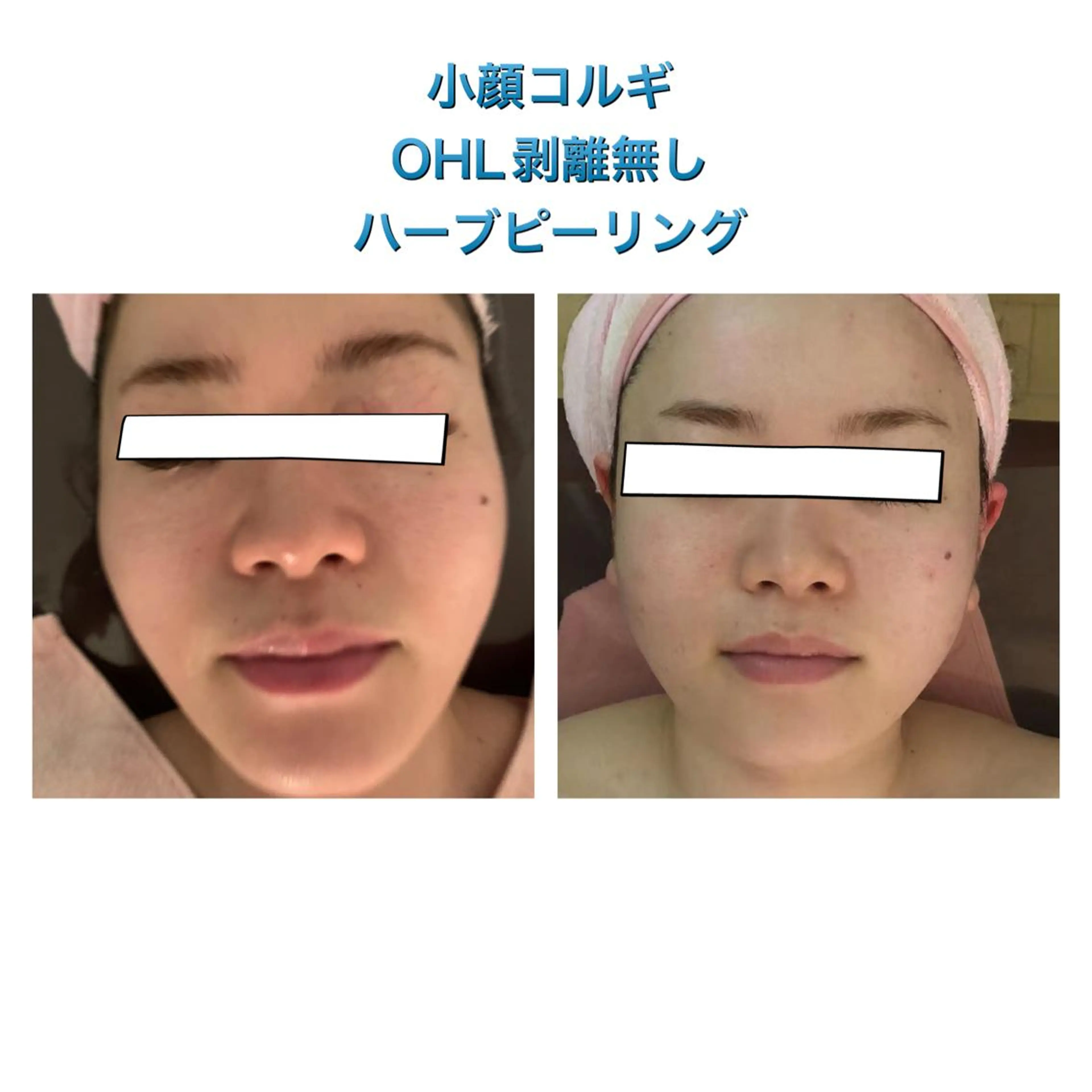 【ハイパーナイフ痩身&小顔コルギ&ハーブピーリング】K-Beauty　東新宿所属・kーbeauty痩身 フェイシャルのエステ・リラクイメージ