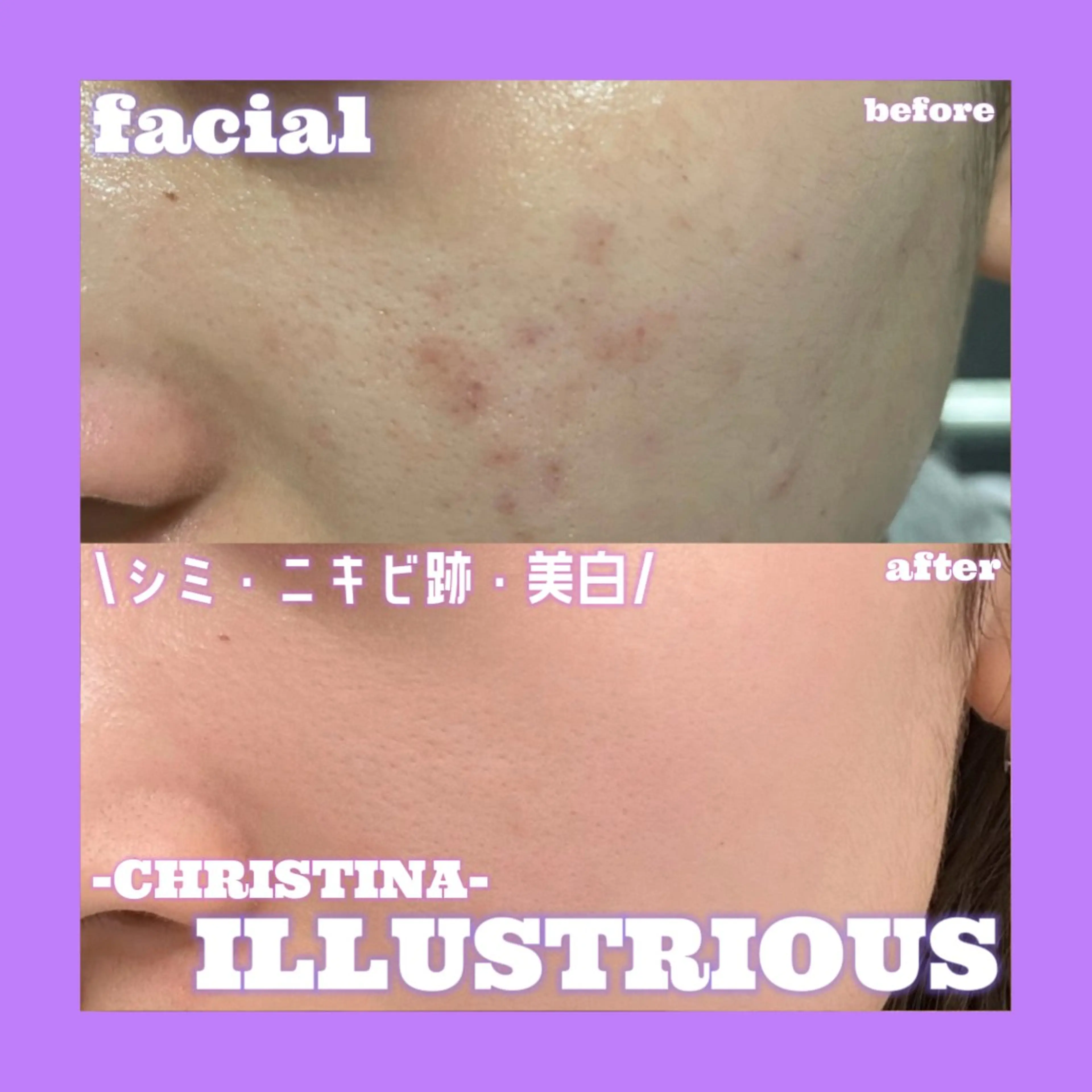 【💜夏に出来たシミを残さない💜】最強美白ピーリング💎シミ・ニキビ跡・色素沈着💫ニキビ跡にも効果的🙆‍♀️✨️の写真