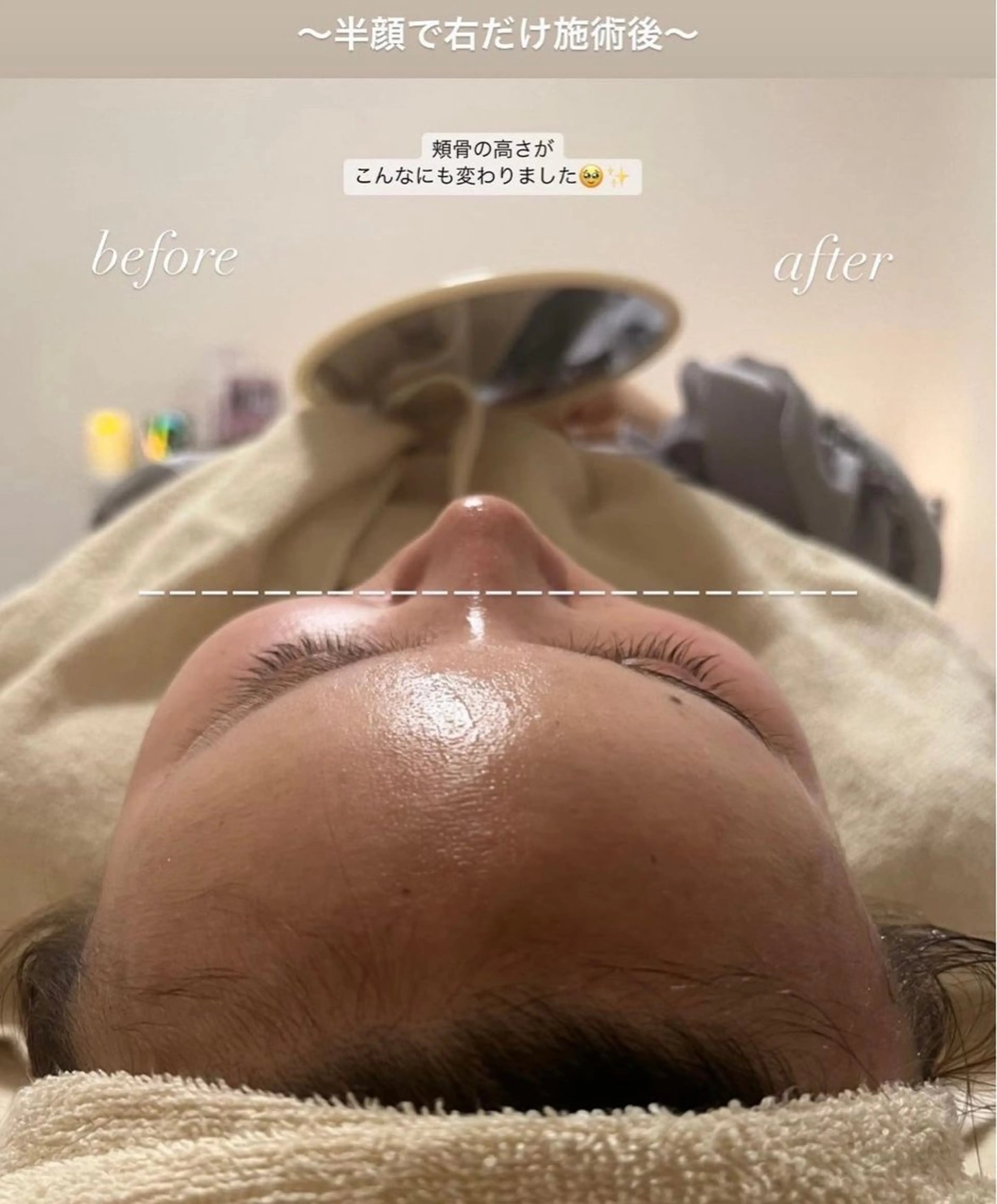 EMSリフトアップコース＆ドライヘッドスパ💆🏼‍♀️ 半額体験で左右の比較を見ていただけます🕊️の写真