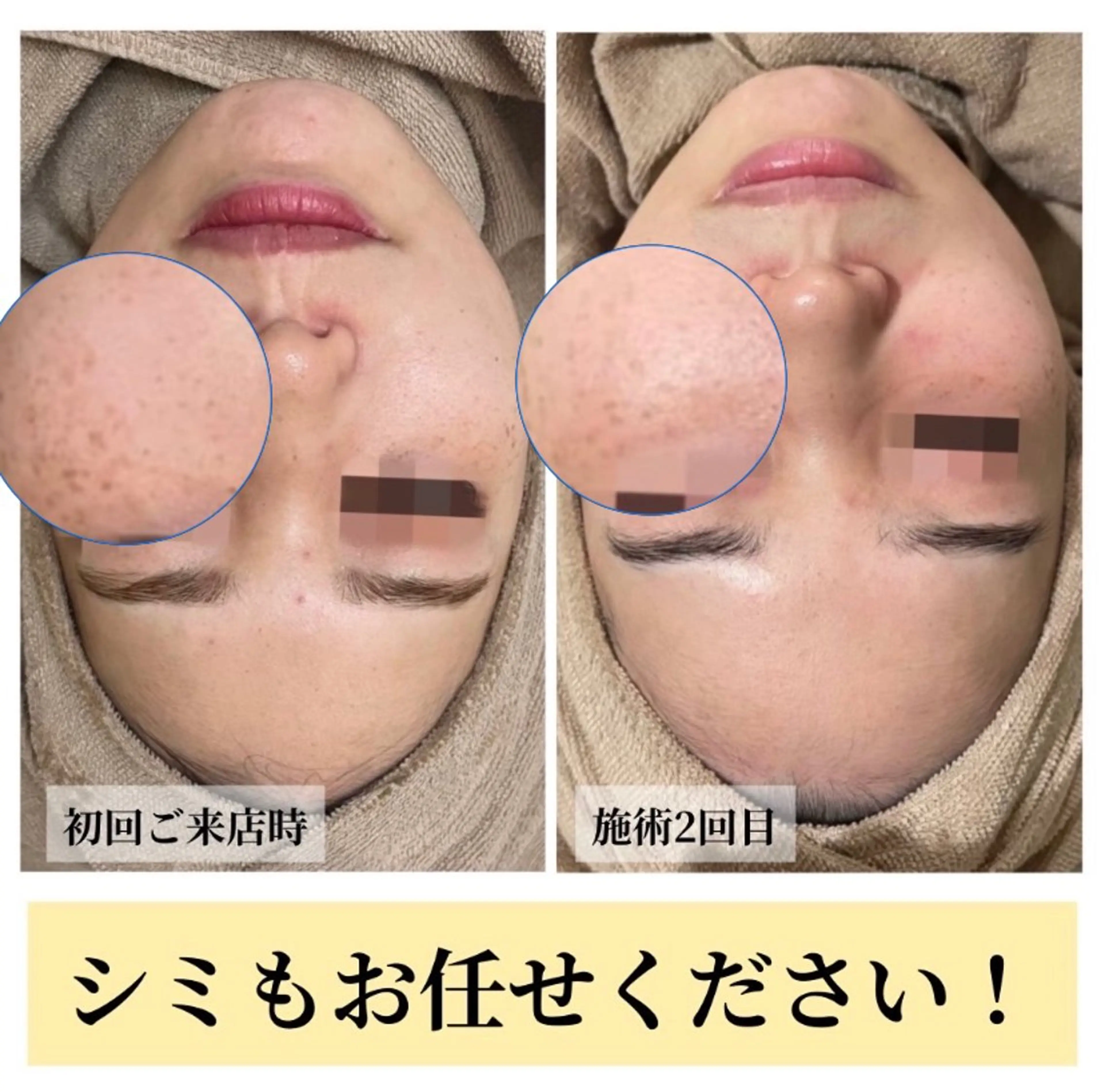 エステ ハーブピーリング・毛穴ケア専門サロンSalon de LENA所属・ハーブピーリング 毛穴専門店/栄のエステ・リラクイメージ