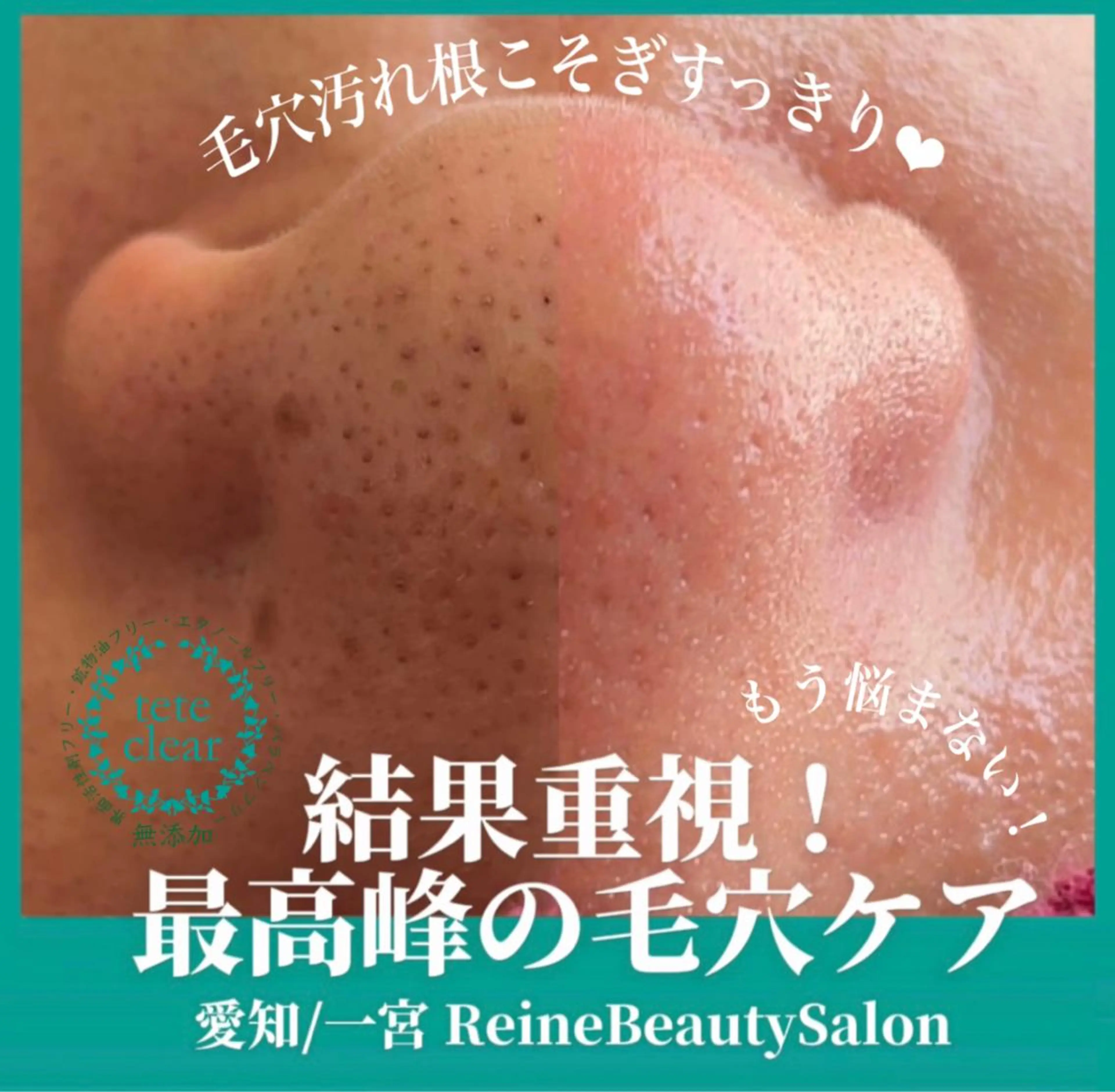 エステ Reine BeautySalon所属・毛穴/シミ肝斑/脱毛 横山梨里のエステ・リラクイメージ