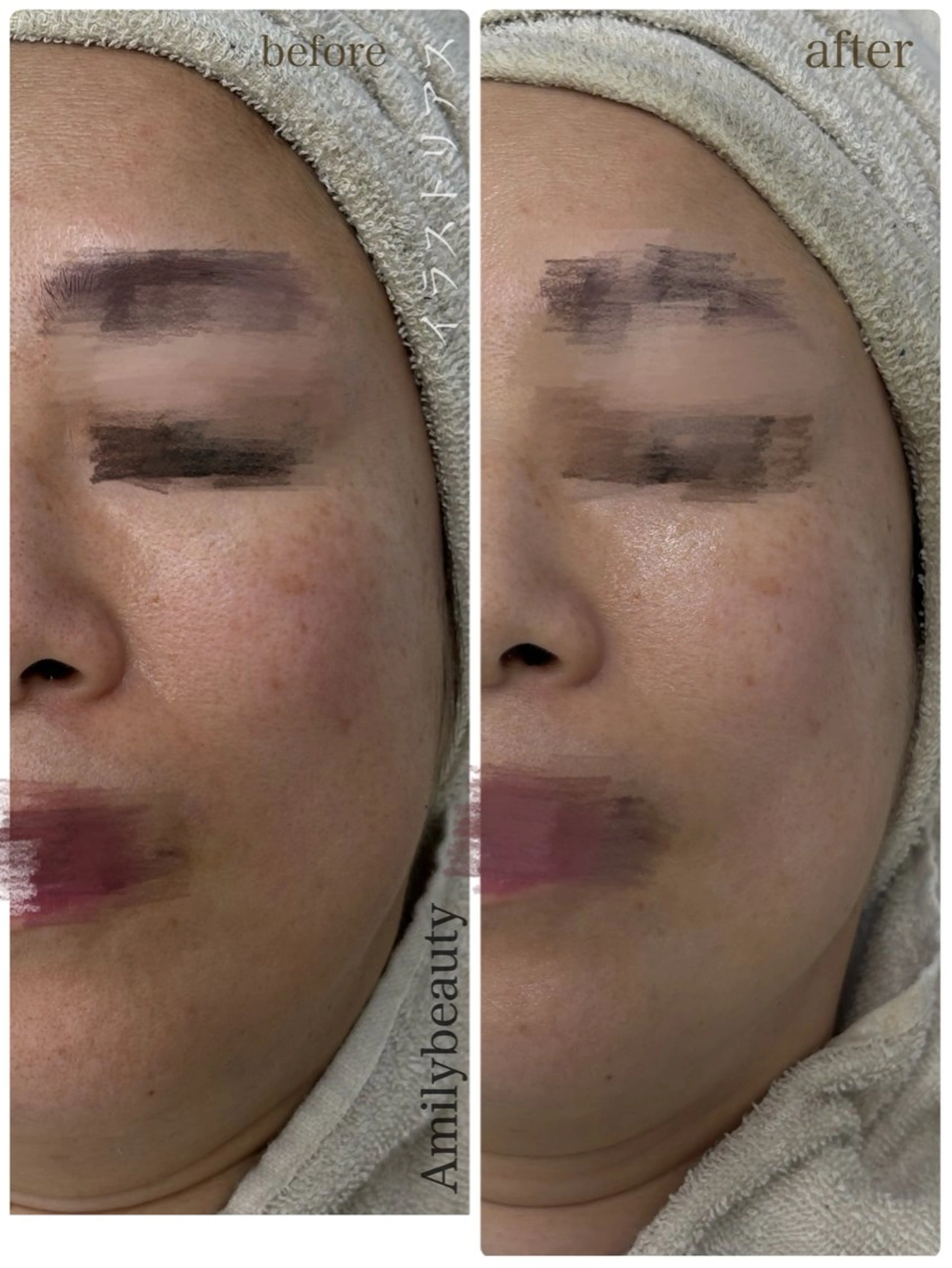 エステ Amily beauty 毛利のその他イメージ