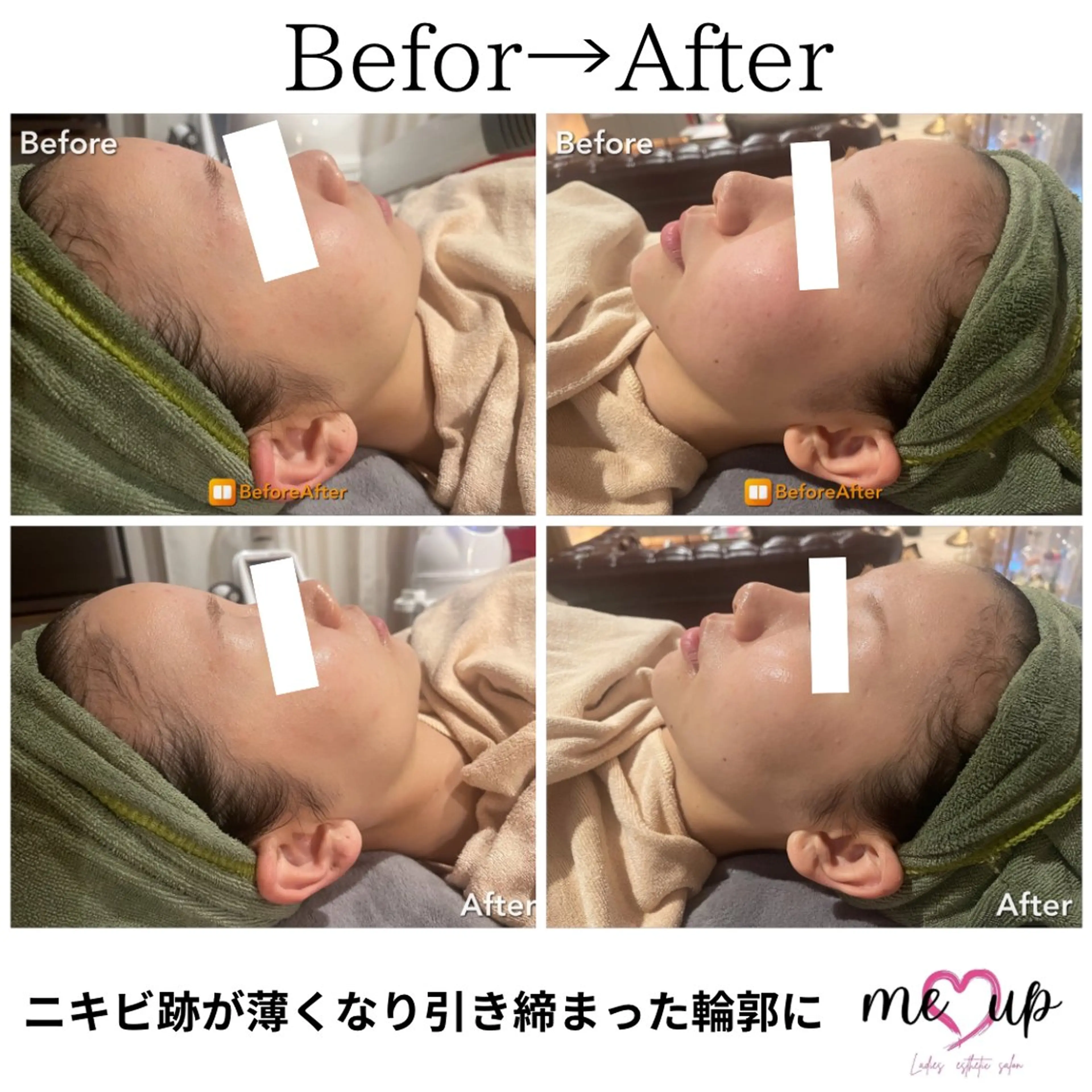 Meupニキビ専門店 背中/ハーブ/ララのその他イメージ