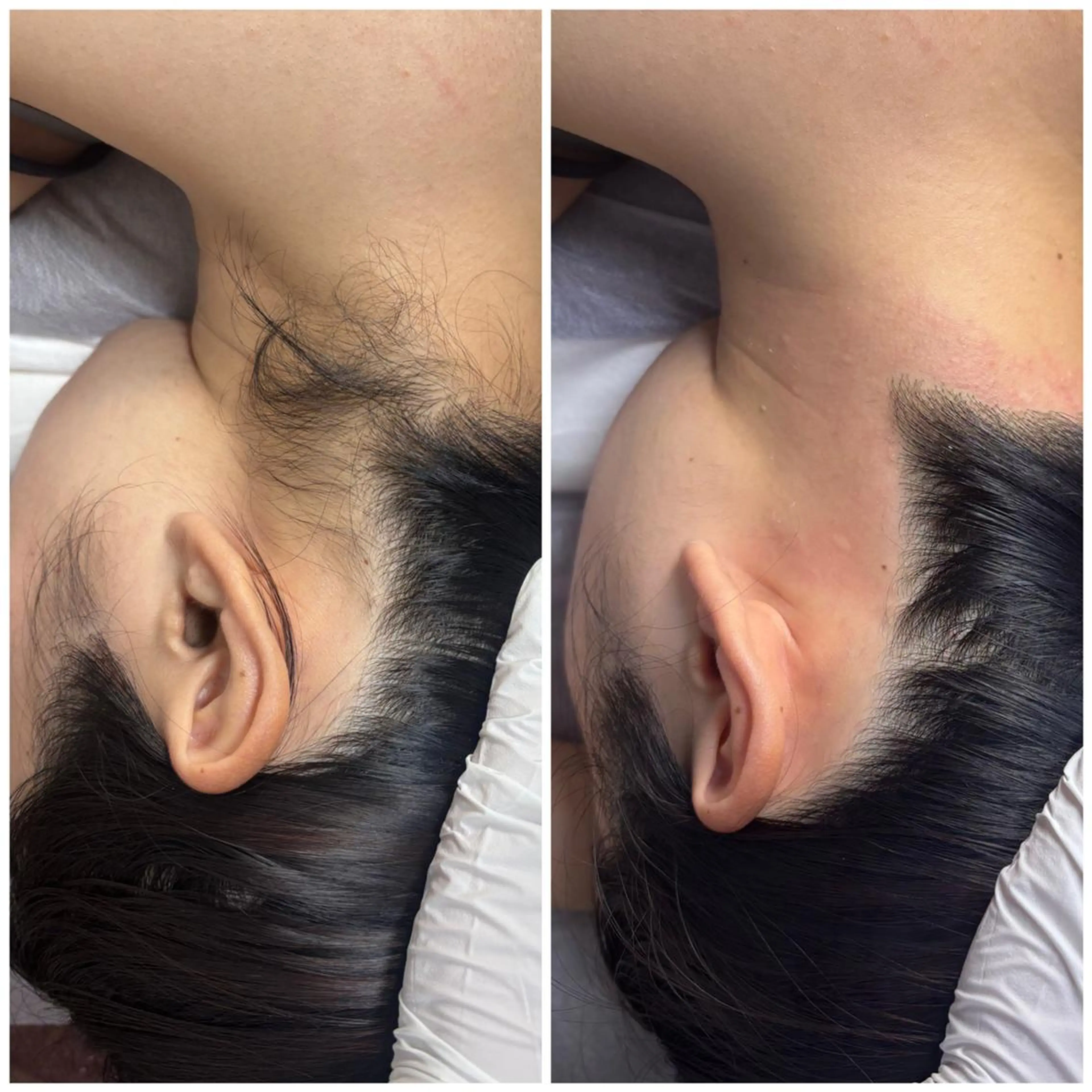【女性全員】うなじWAXの写真