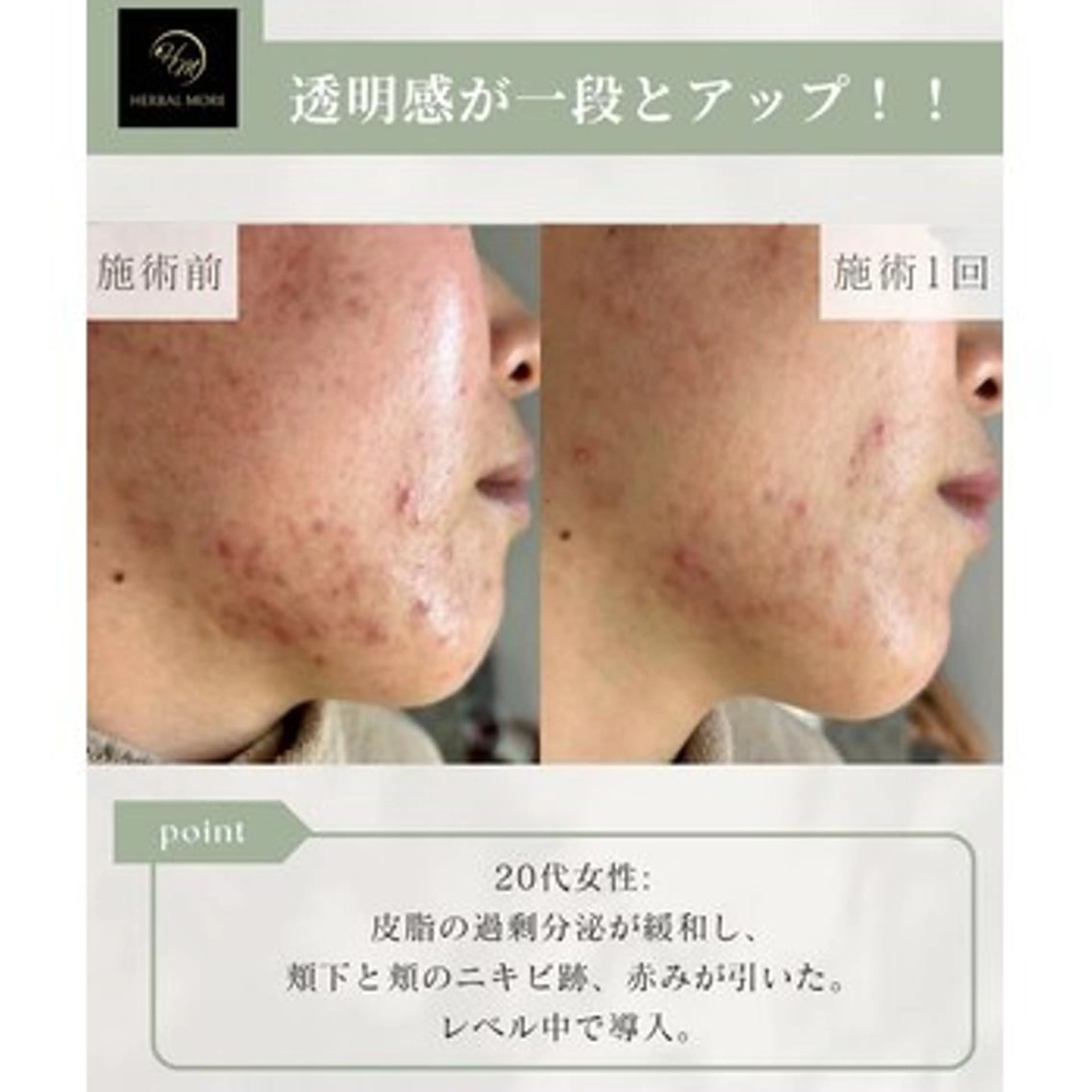 【ニキビ/凸凹肌が気になる方】剥けるハーブピーリング＋鎮静パックの写真