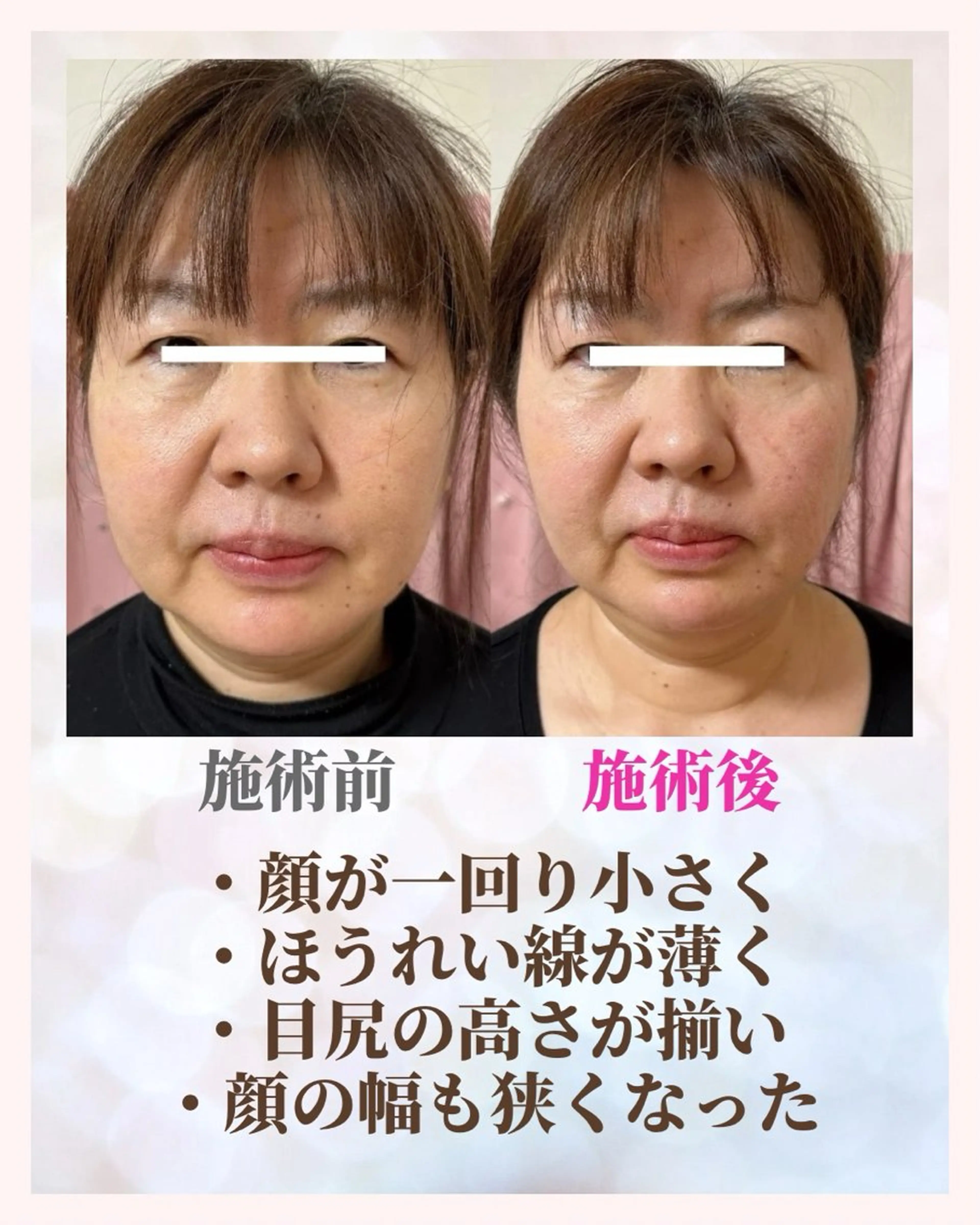 痩身・小顔・骨盤矯正×ヒップアップ専門エステ Peach所属・桃尻つかさ🍑小顔× ノーファンデ肌作りのエステ・リラクイメージ