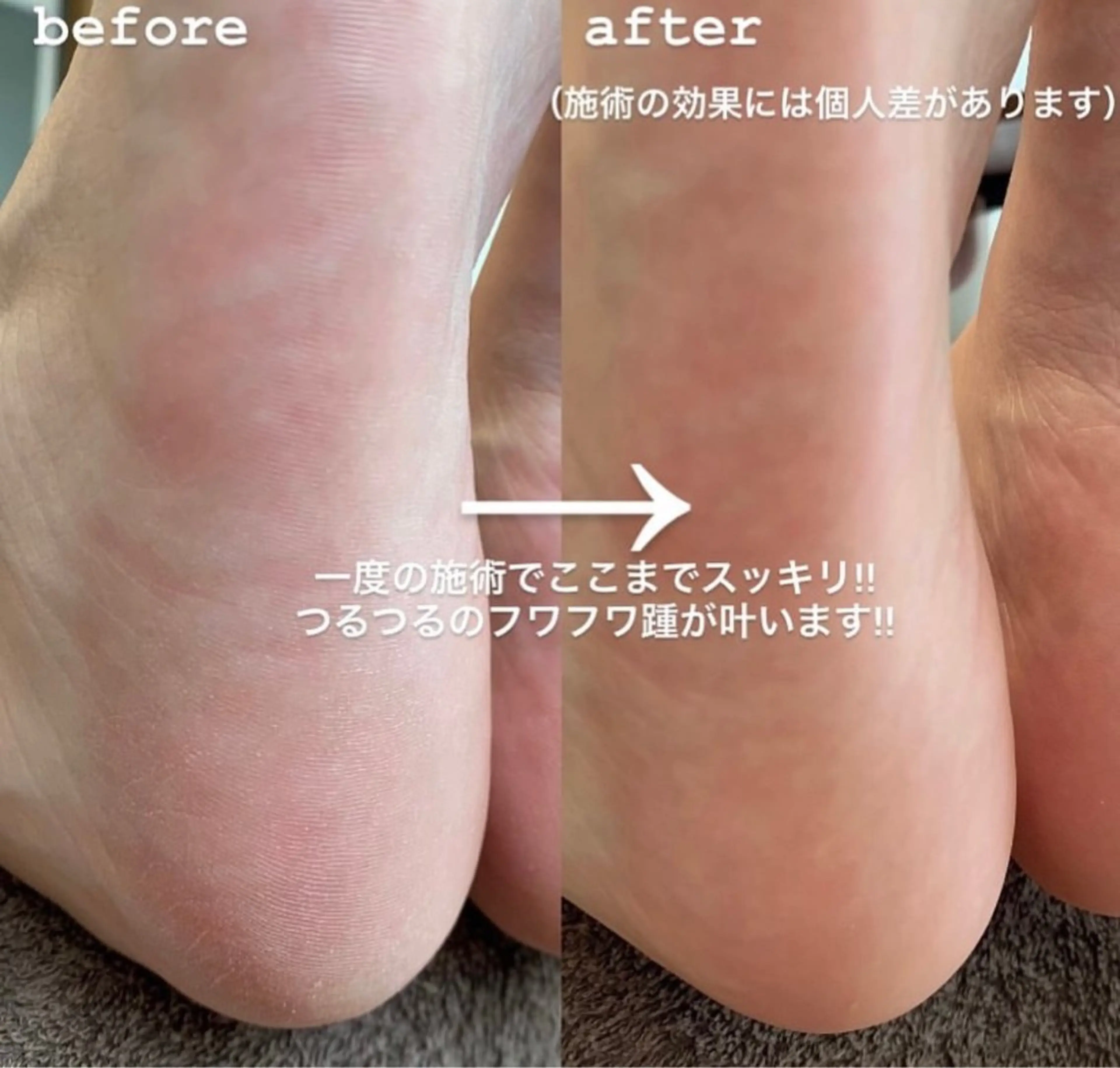 フットケア 角質除去（足裏の硬くなった皮膚のお手入れ)足元潤いとすべすべなお肌にの写真