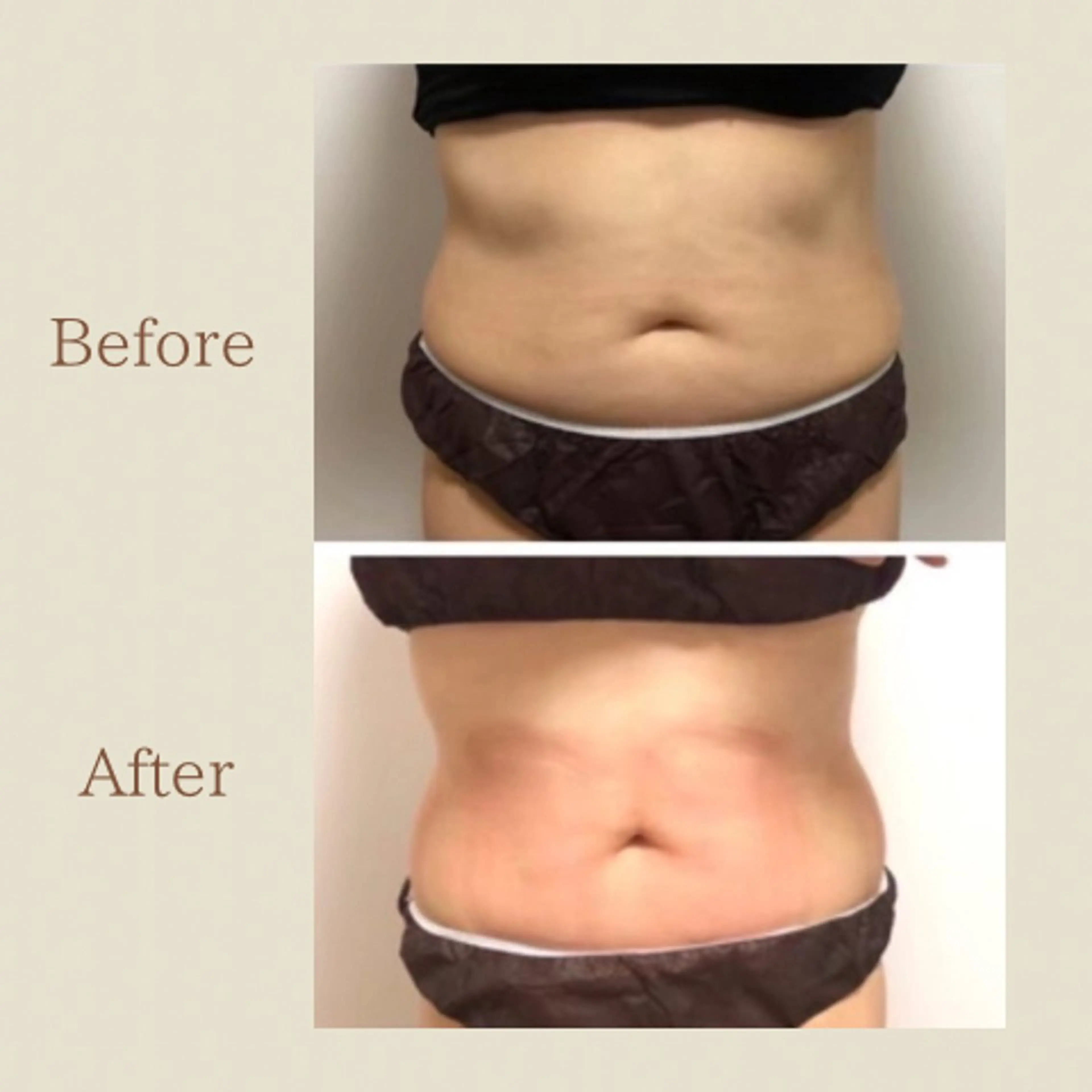 お腹痩せエステ Flat BELLY 恵比寿所属・【腸もみ/脂肪冷却】 お腹エステ/恵比寿のエステ・リラクイメージ