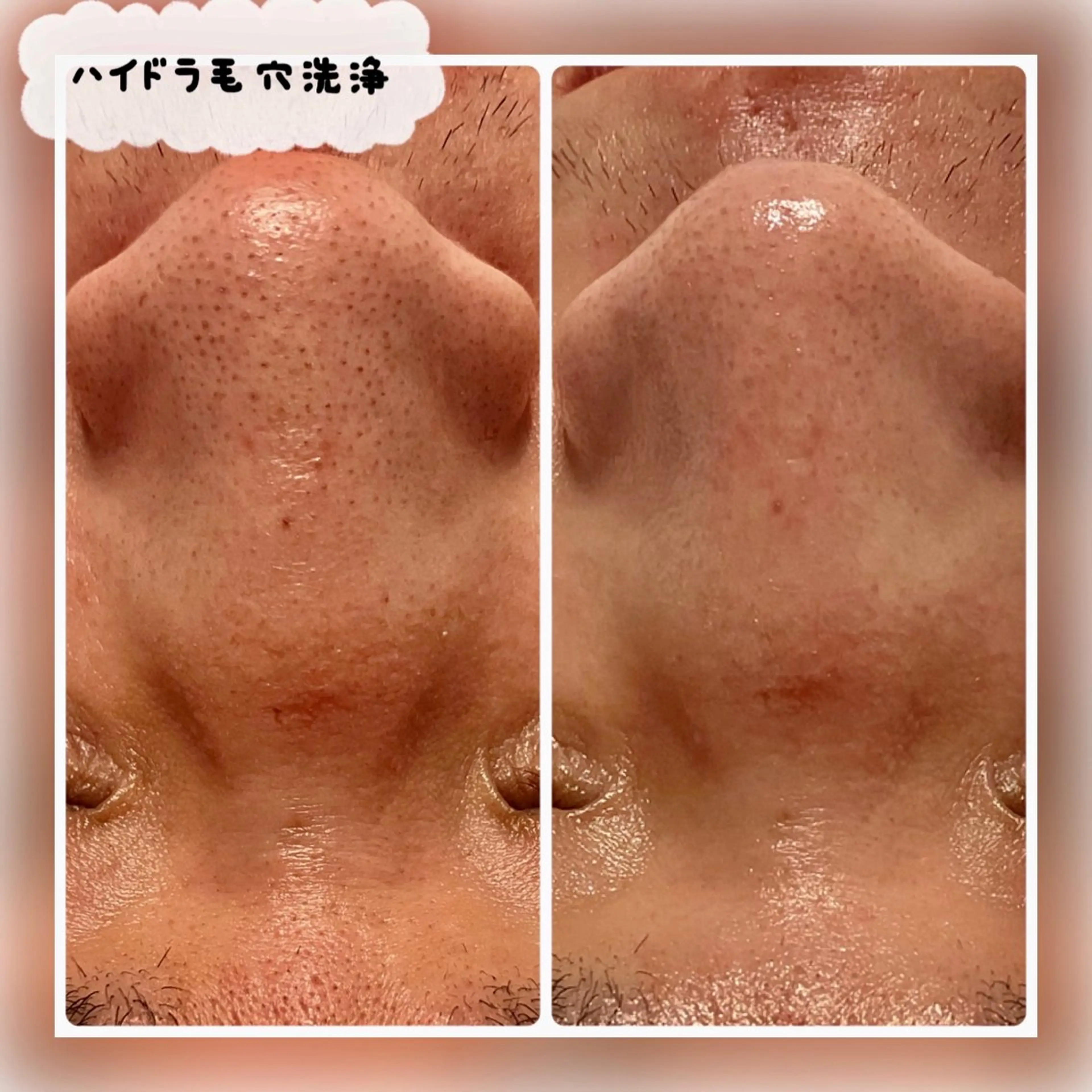 メンズ限定！！毛穴の汚れや古い角質皮脂をしっかり取りお肌のターンオーバーの正常化を促進毛穴詰まり開き毛穴黒ずみの解消にの写真