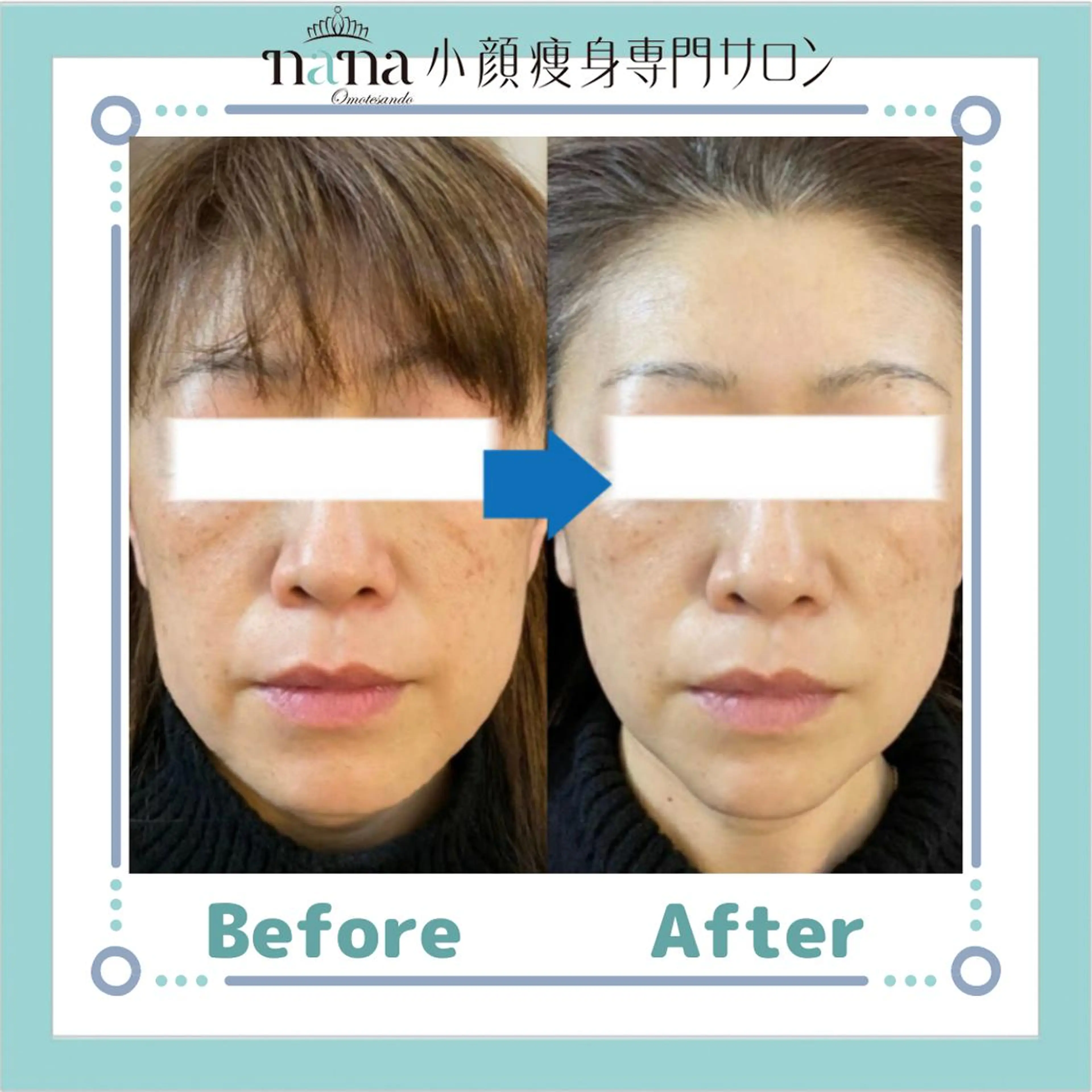 メンズ 小顔痩身インディバ Nana表参道のエステ・リラクイメージ