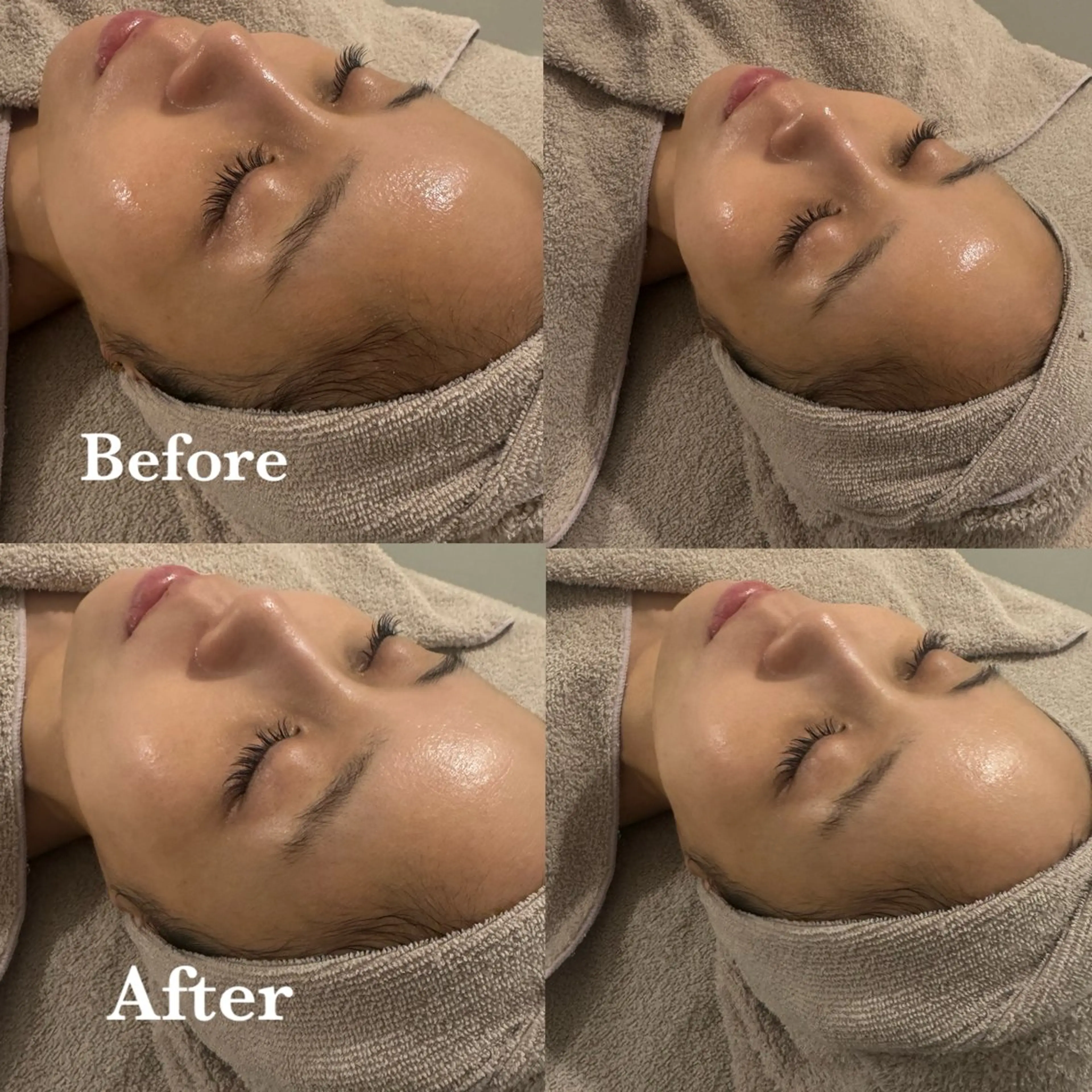 【美白】フェイシャルエステ・パック込み💆🏻‍♀️🫧圧倒的な透明感と美白ケアで夏の日焼けお疲れ肌をリセット🌈の写真