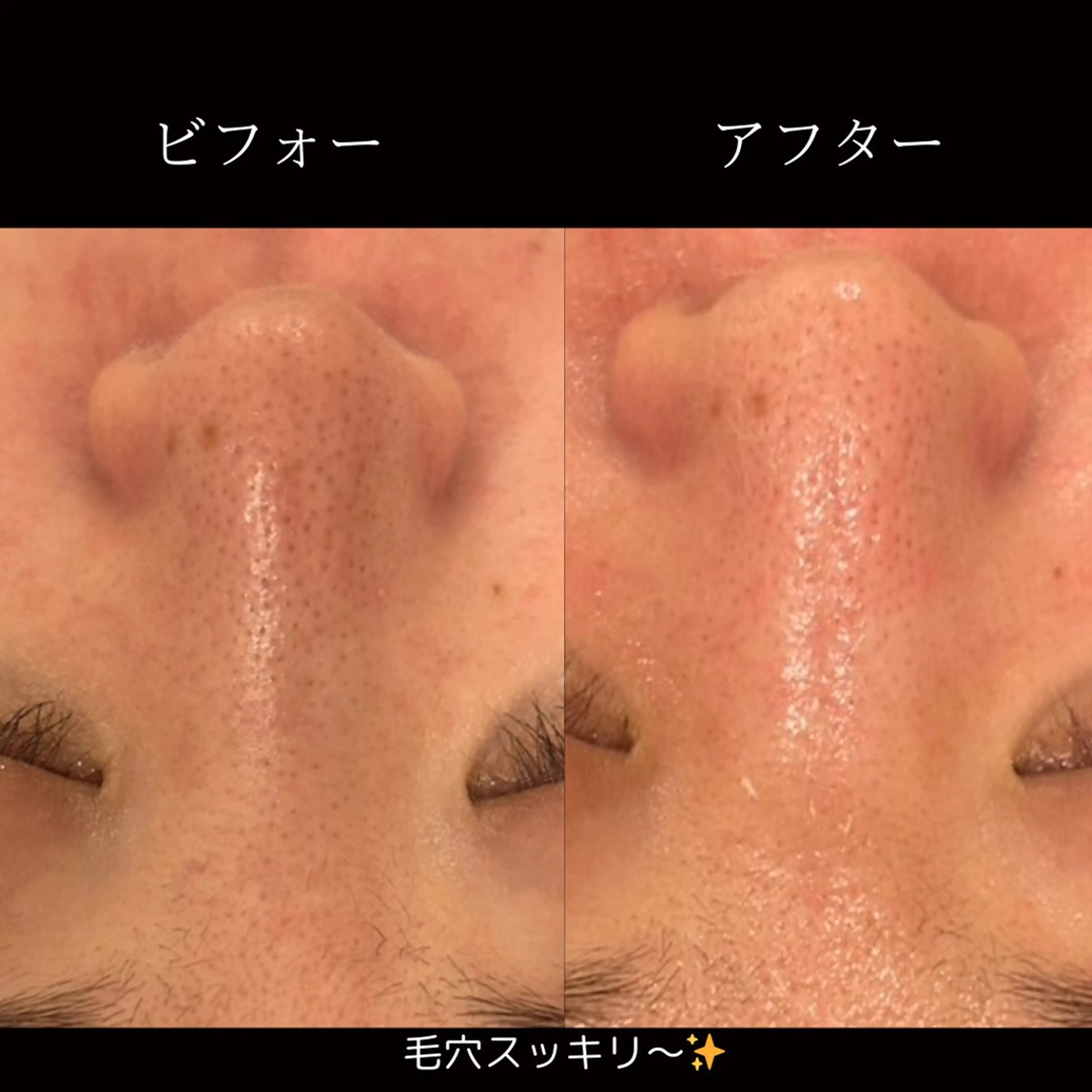 エステ NiU.BEAUTY🥥池袋店所属・ハーブピーリング専門 NiU.BEAUTYのエステ・リラクイメージ