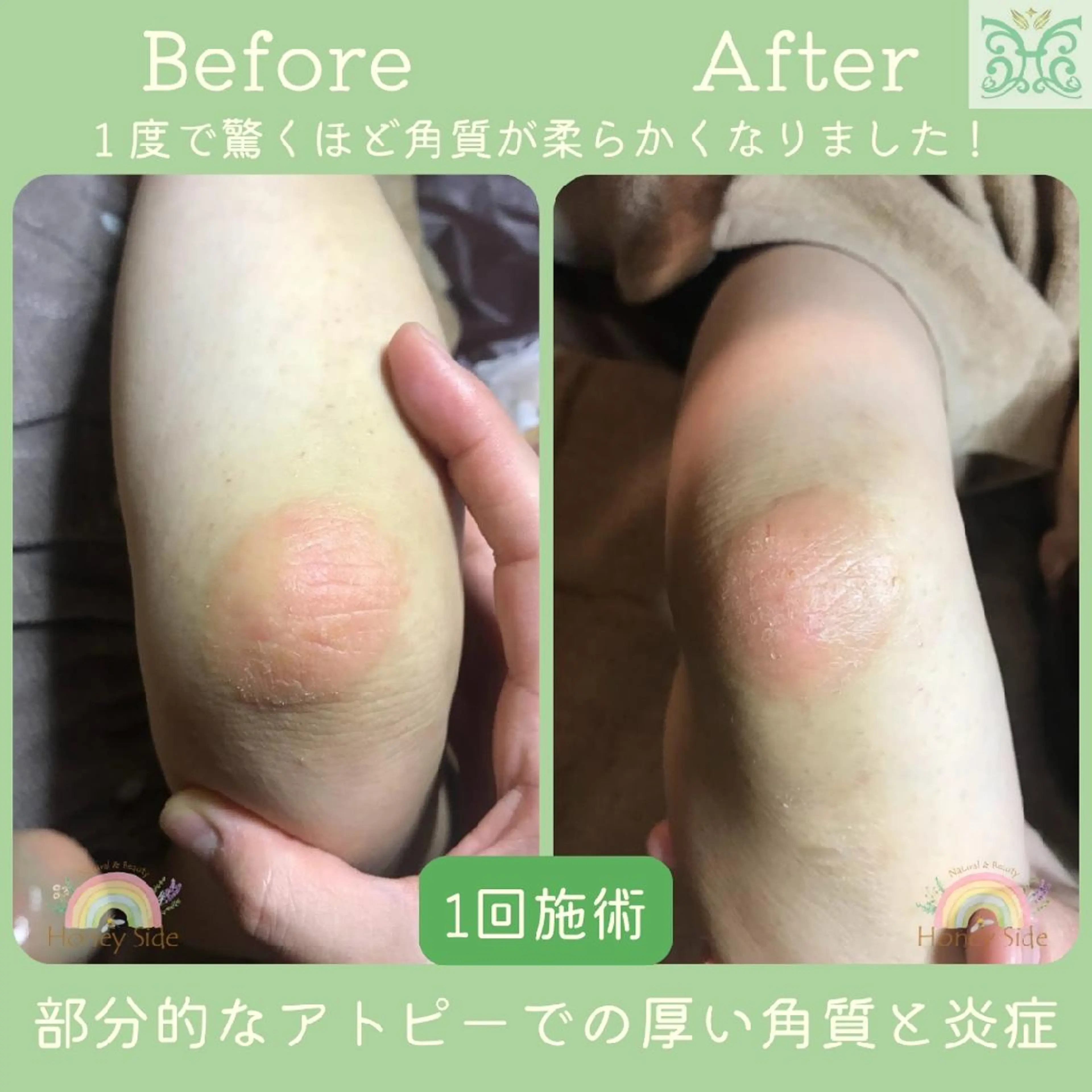 エステ 剥離するハーブ🌈 Honey Sideのエステ・リラクイメージ