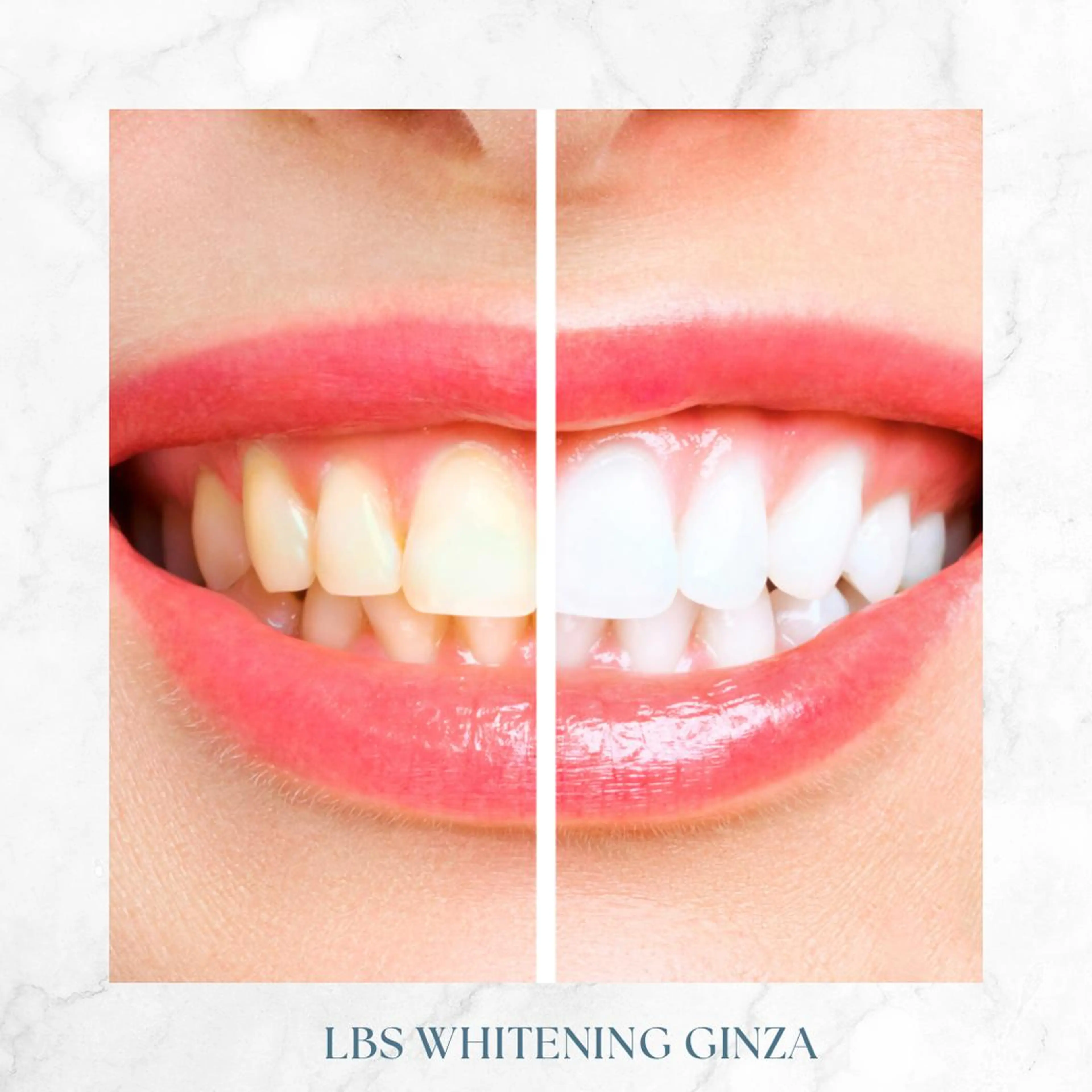 ミディアム メンズ カラー LBSホワイトニング 銀座店💎公式のその他イメージ