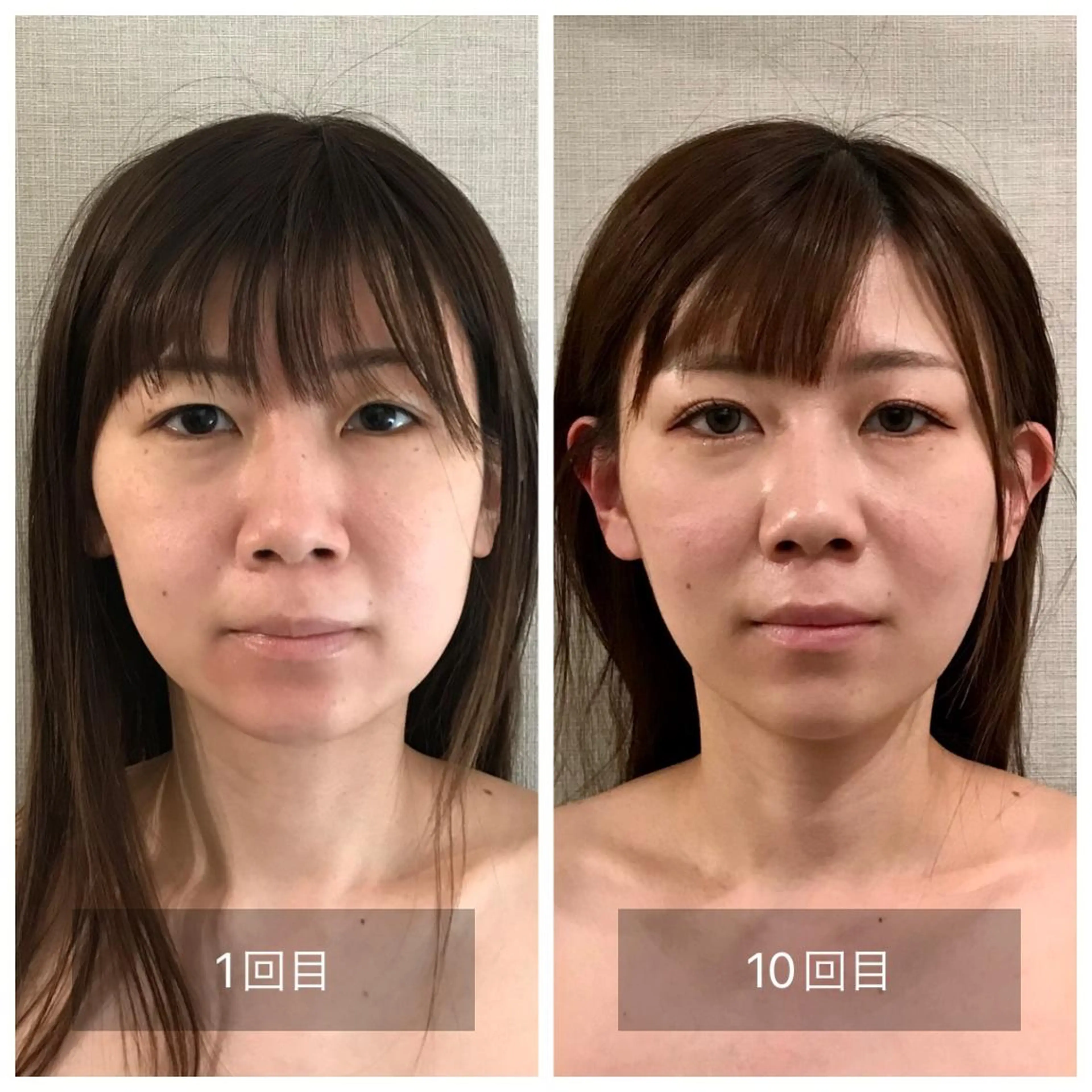 新宿hari-me所属・美容鍼hari-me 新宿のエステ・リラクイメージ