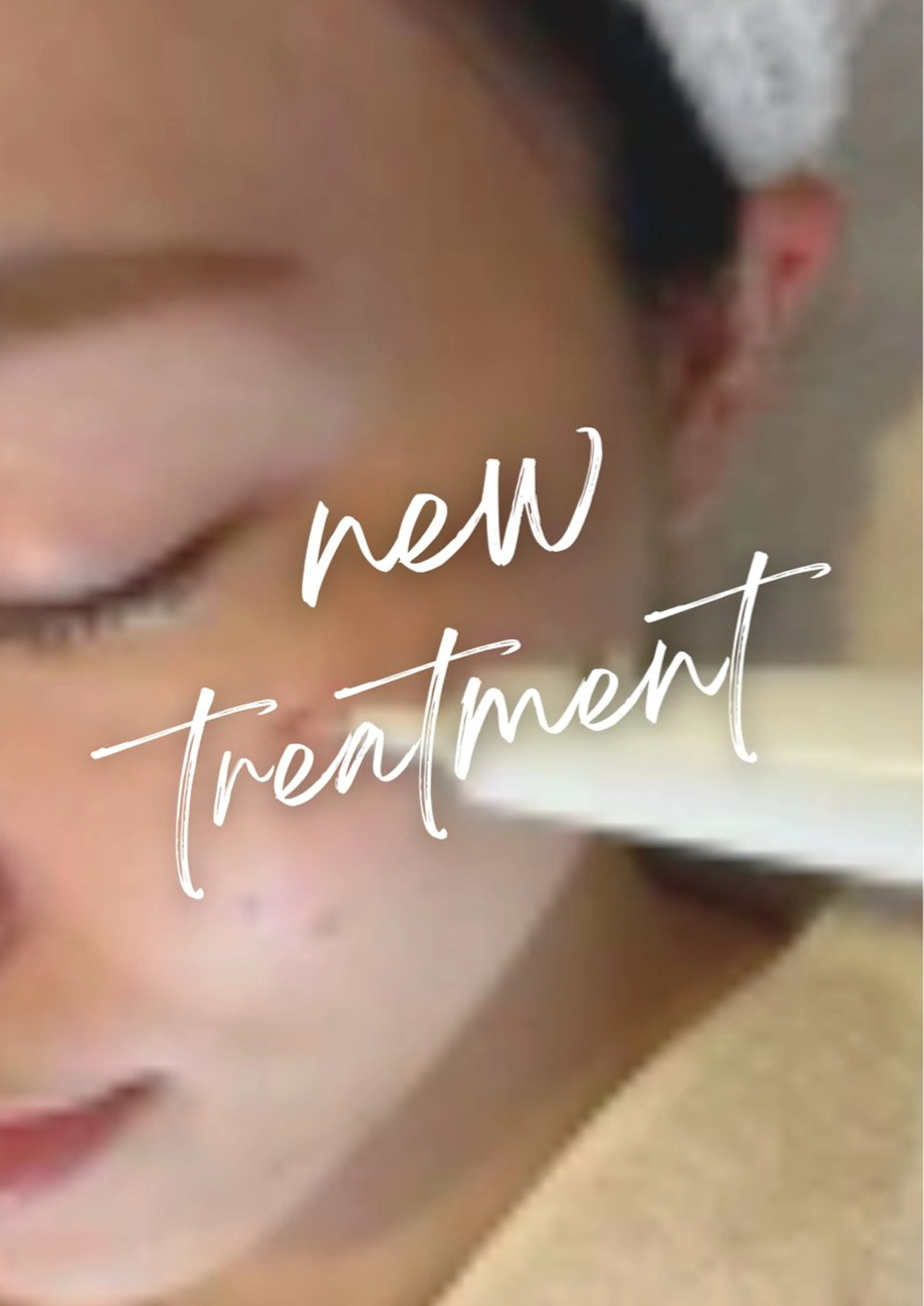 20代の方限定🪻シミ・そばかすケア【10分あて放題】の写真