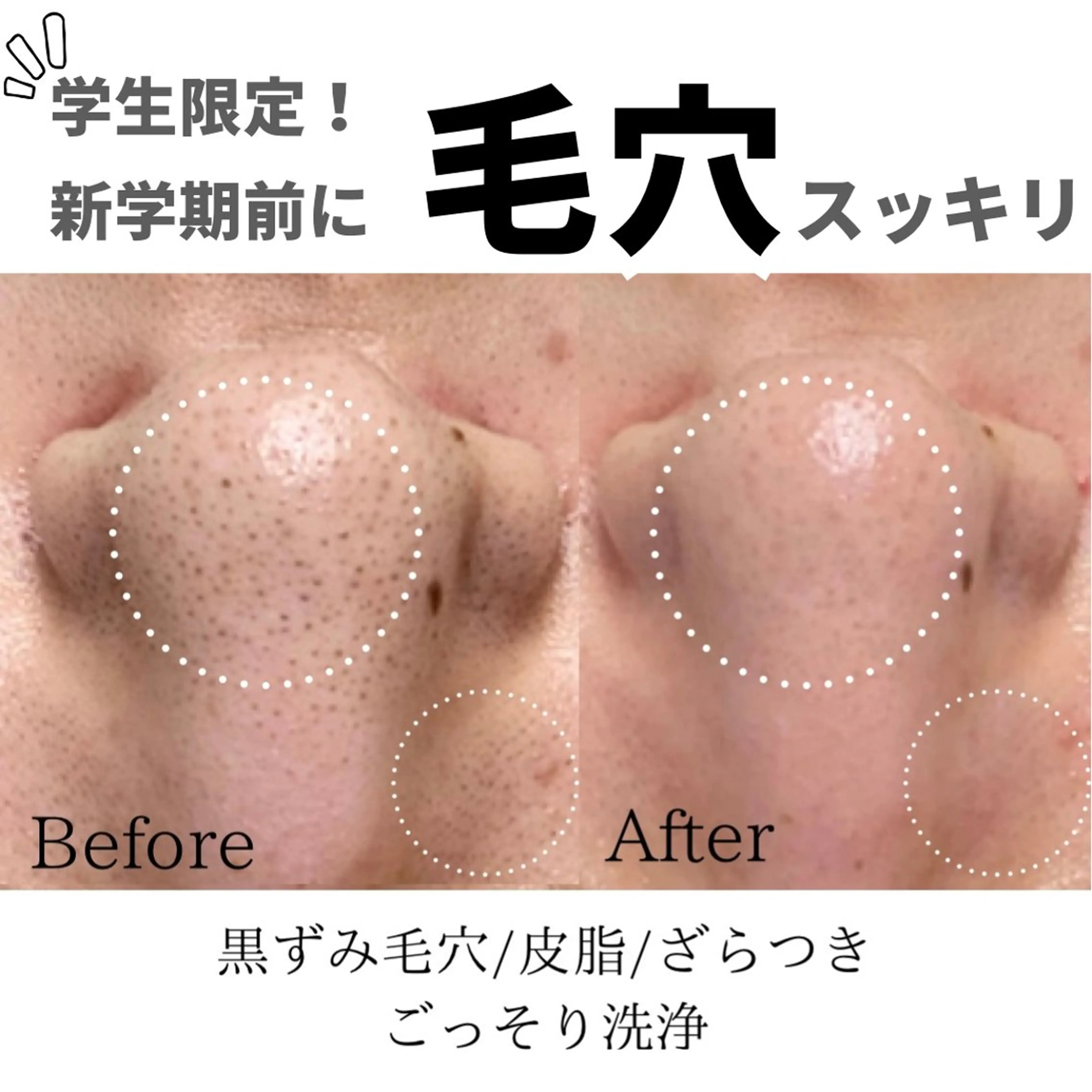 【学生限定⏳口コミ必須🗣️】大人気ハイドラフェイシャルで毛穴汚れをごっそり洗浄！ﾂﾔ肌で第一印象UP！の写真