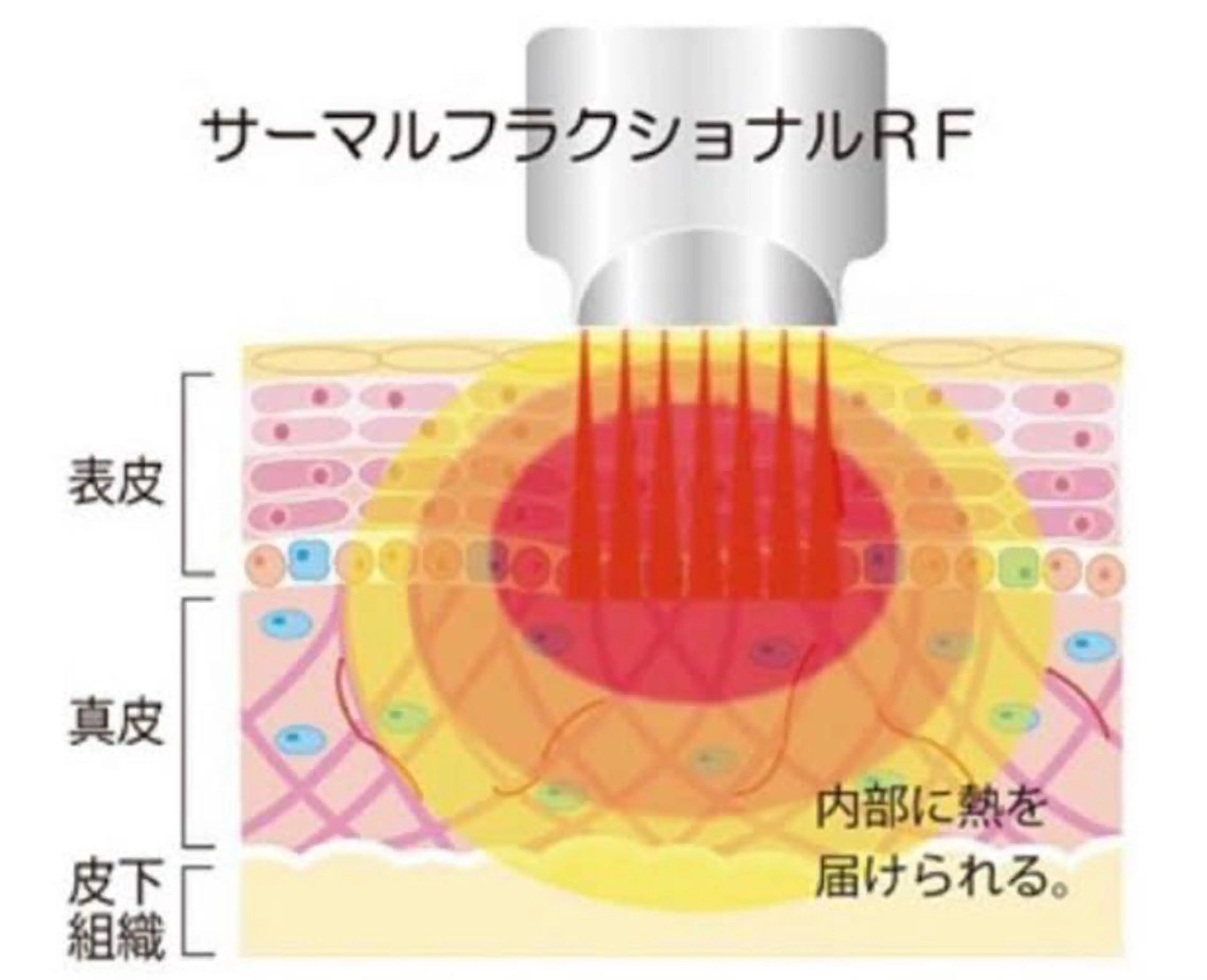 サーマルフラクショナルは肌の奥深くまで熱エネルギーを届け、コラーゲン促進＆毛穴引き締め＆小顔＆リフトアップにオススメの写真