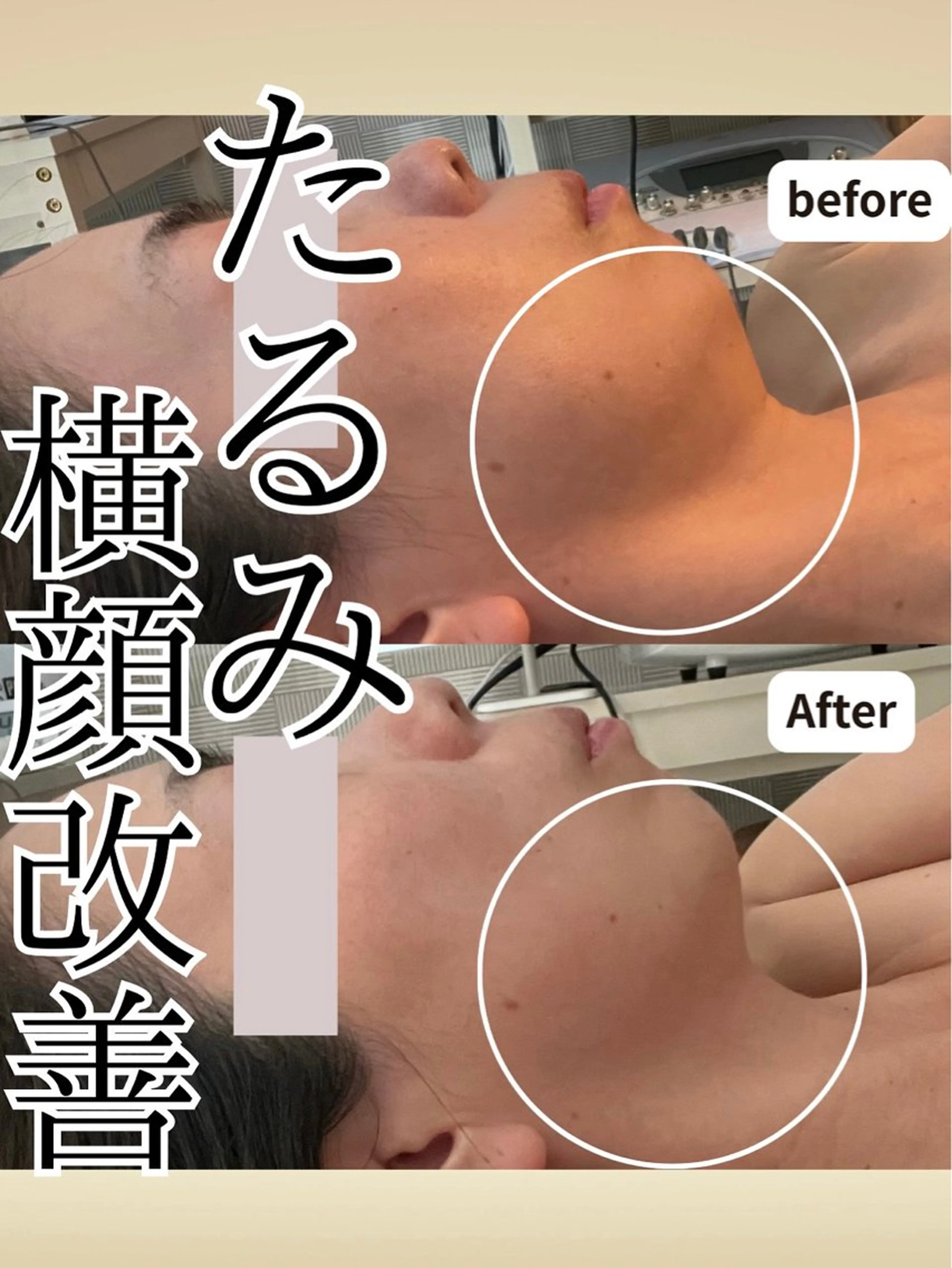 Wリフトアップフェイシャルの写真