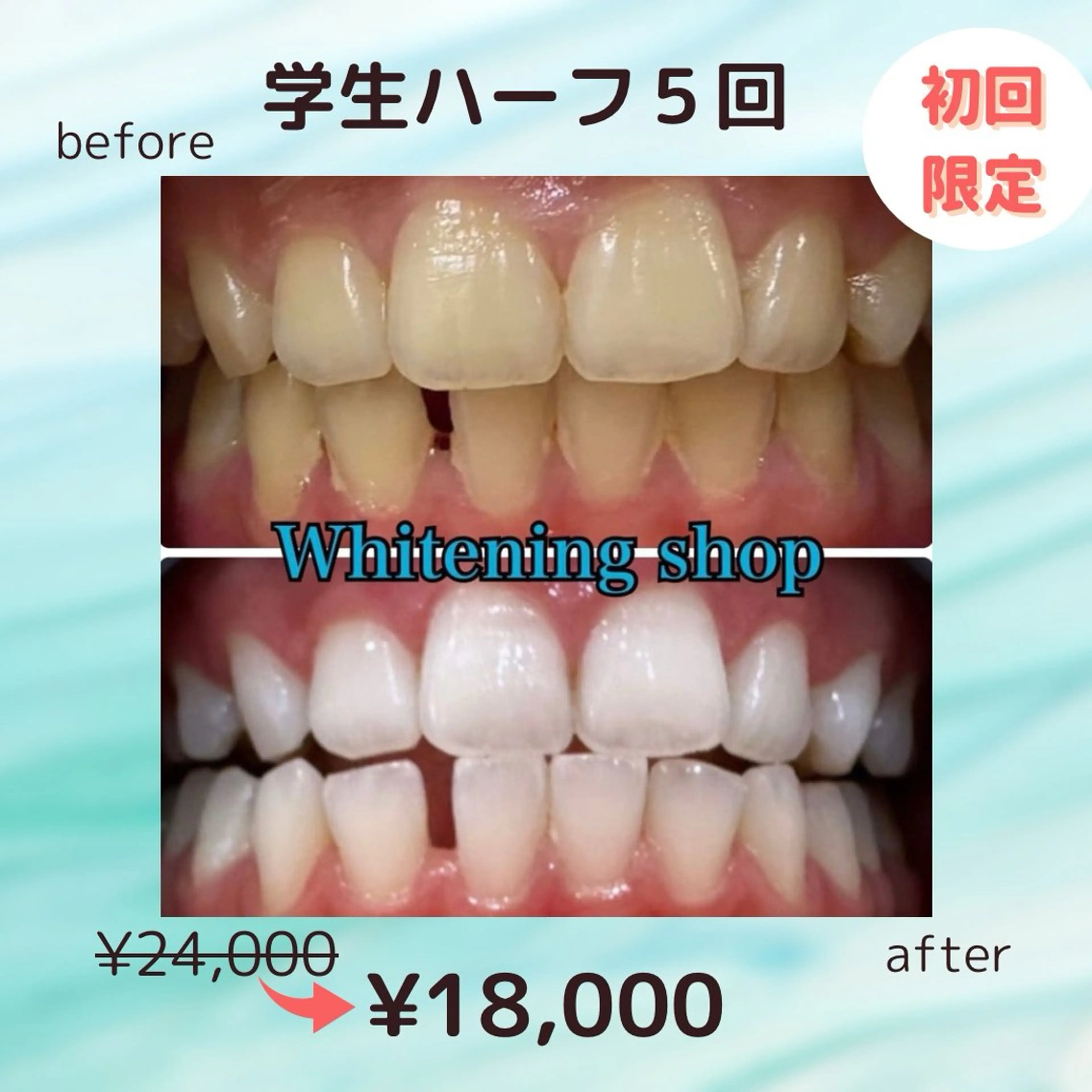 💎ミニモ学割U24割💎美白ホワイトニング 20分✕10回照射¥24,000→¥18,000の写真