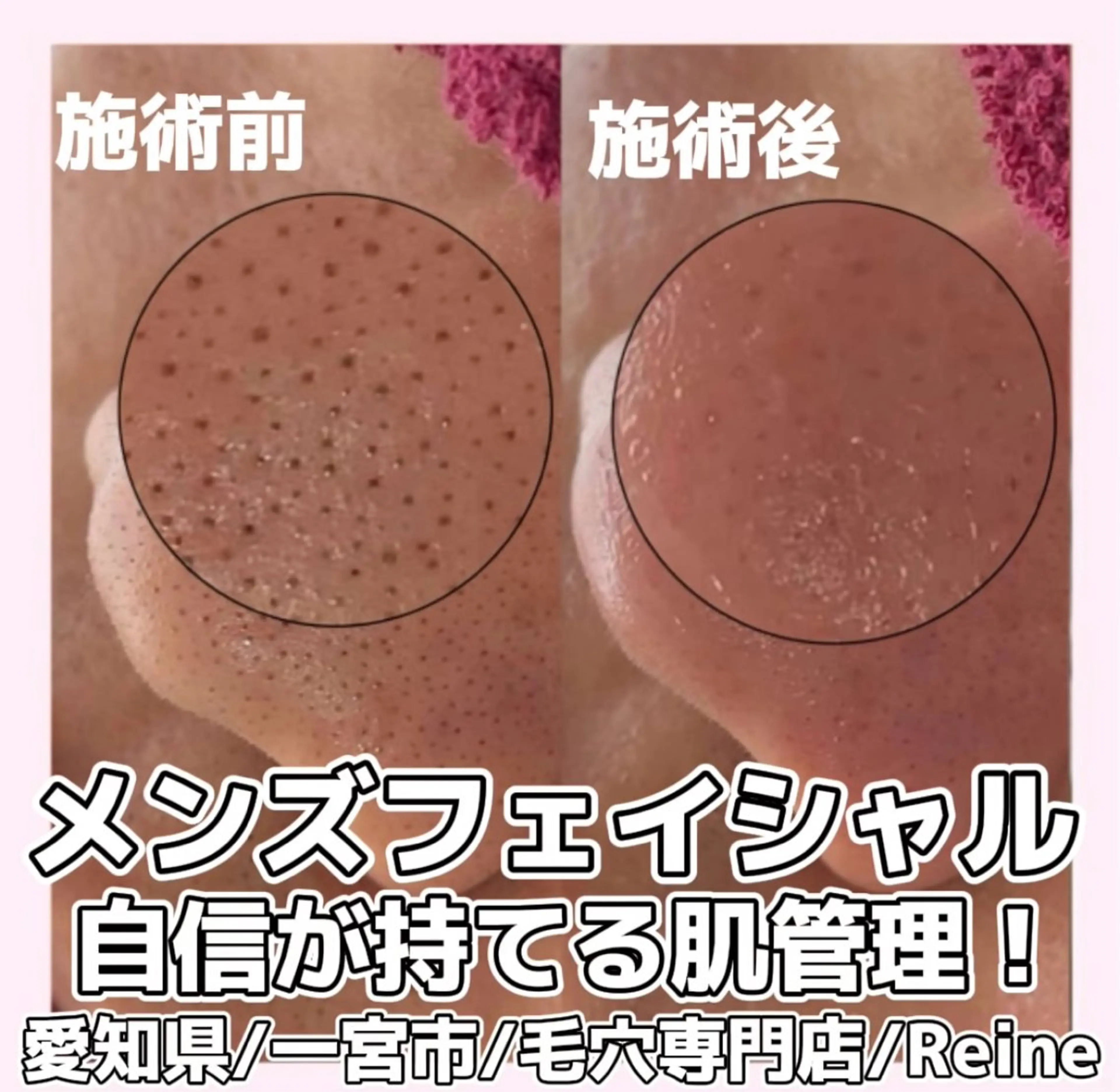 エステ Reine BeautySalon所属・毛穴/シミ肝斑/脱毛 横山梨里のエステ・リラクイメージ