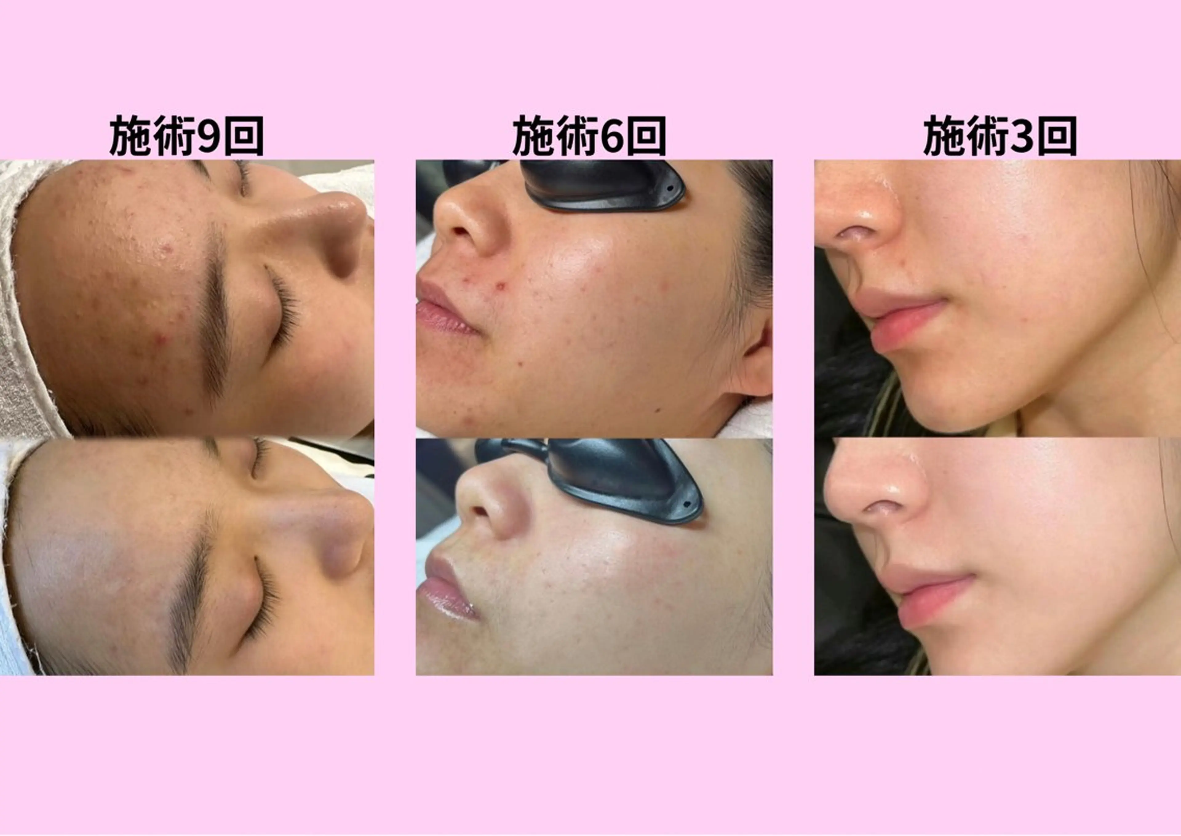 エステ 愛維美水光美肌専門店所属・愛維美水光美肌専門店 メンズレディースokのエステ・リラクイメージ