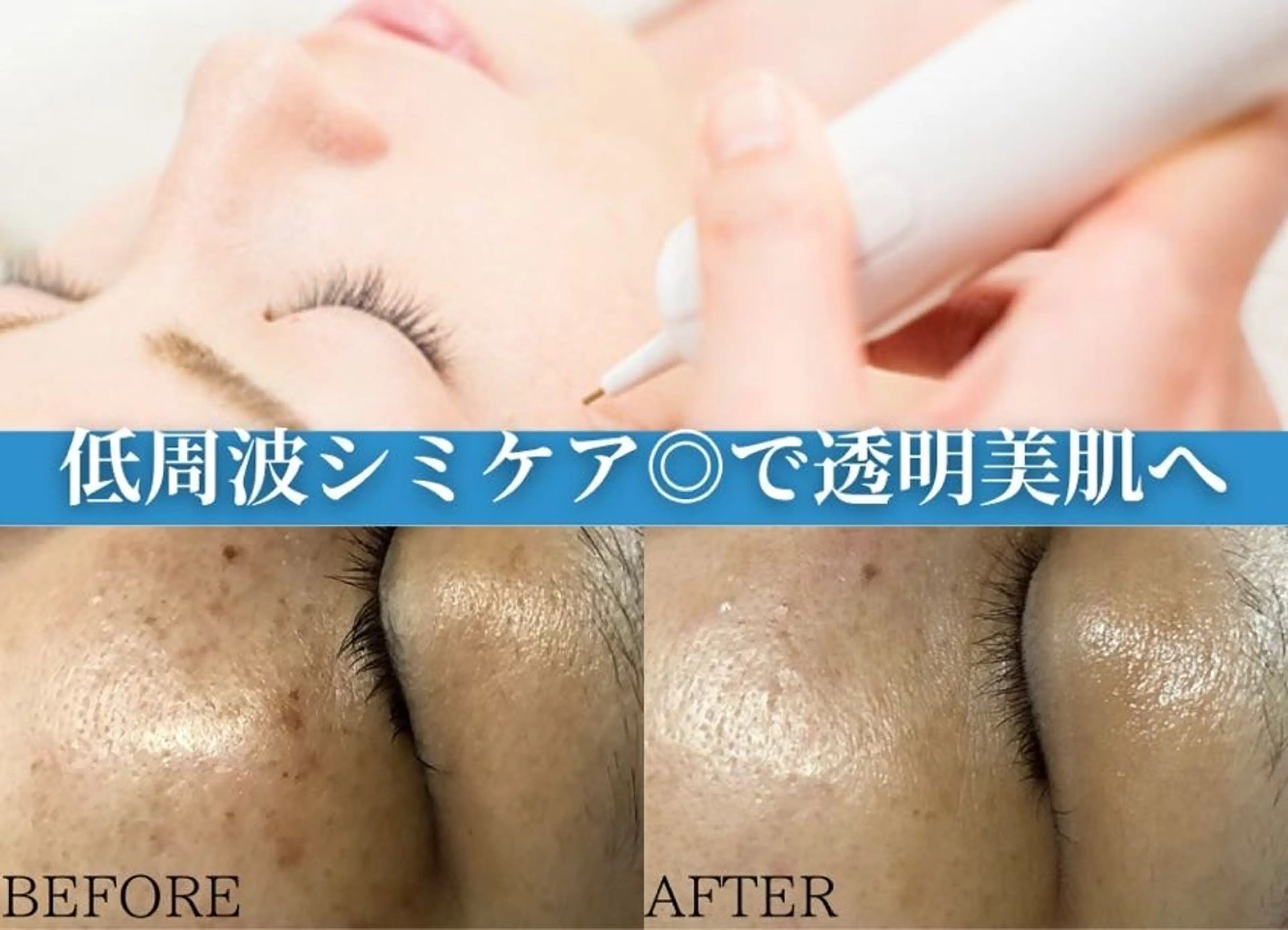 💎20分間シミ取り放題💎マスク生活のうちにシミをデトックス！※ダウンタイム有りの写真