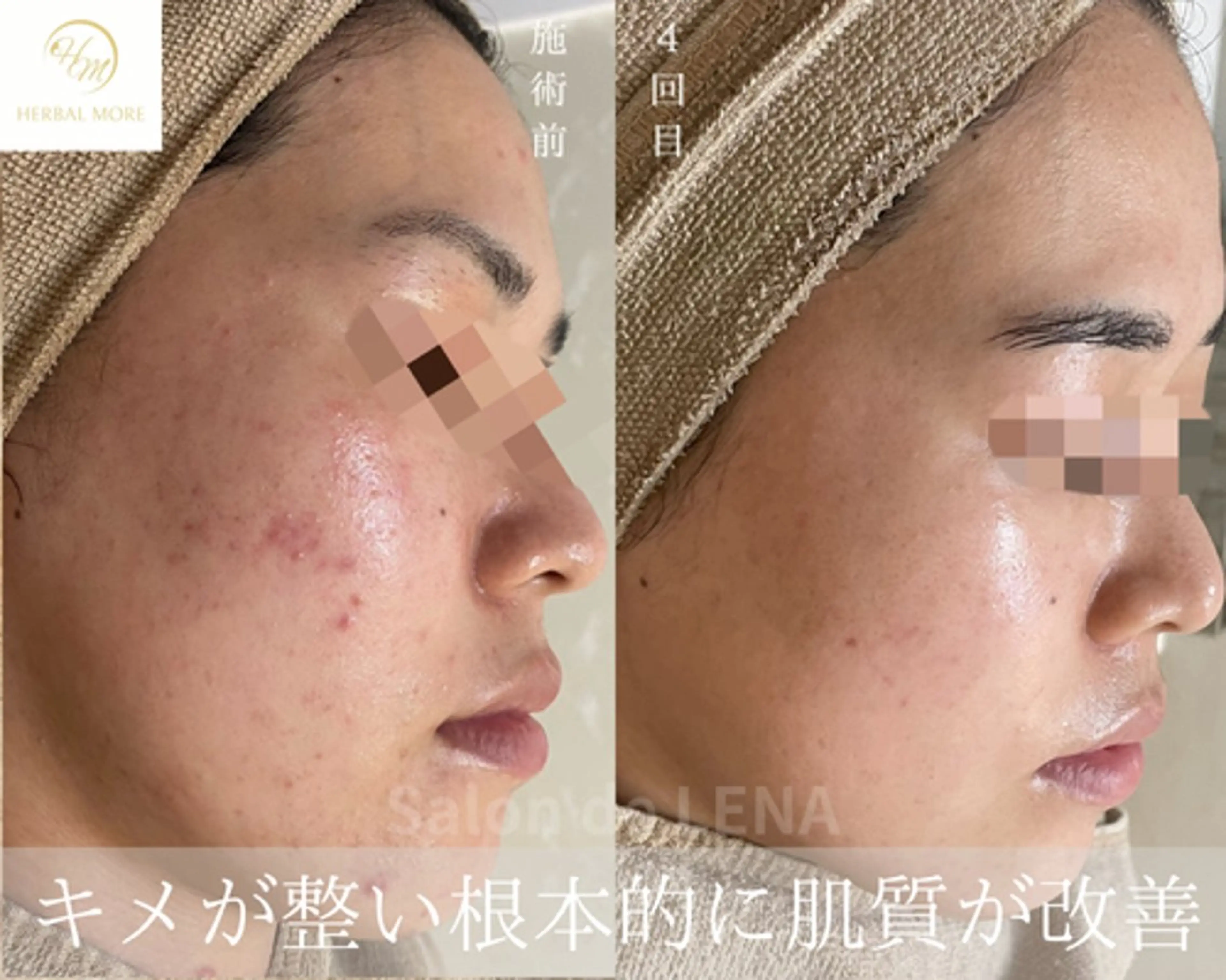 ハーブピーリング・毛穴ケア専門サロンSalon de LENA 栄店所属・ハーブピーリング専門 サロンドレナ　白藤のエステ・リラクイメージ